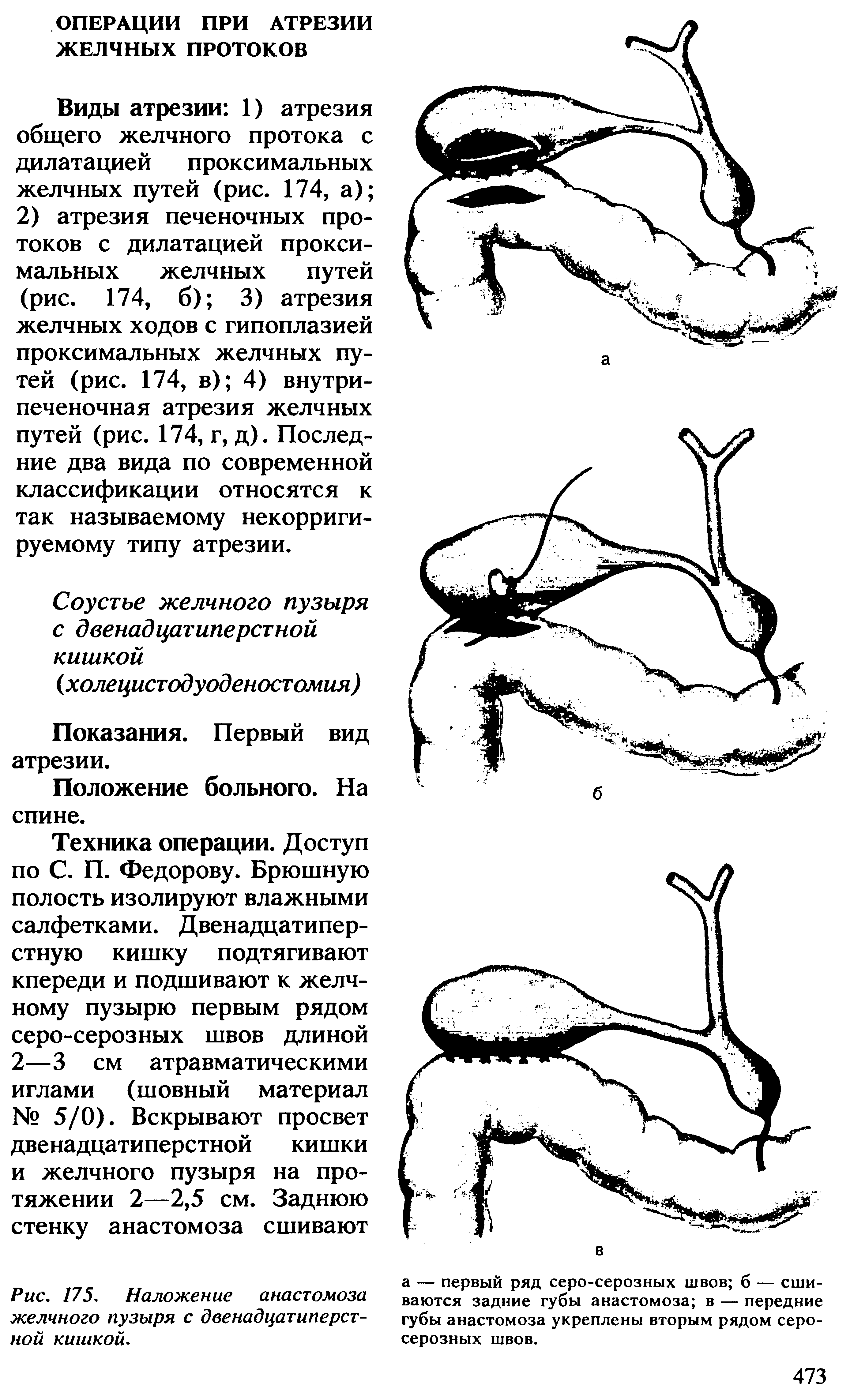 Рис. 175. Наложение анастомоза желчного пузыря с двенадцатиперстной кишкой.