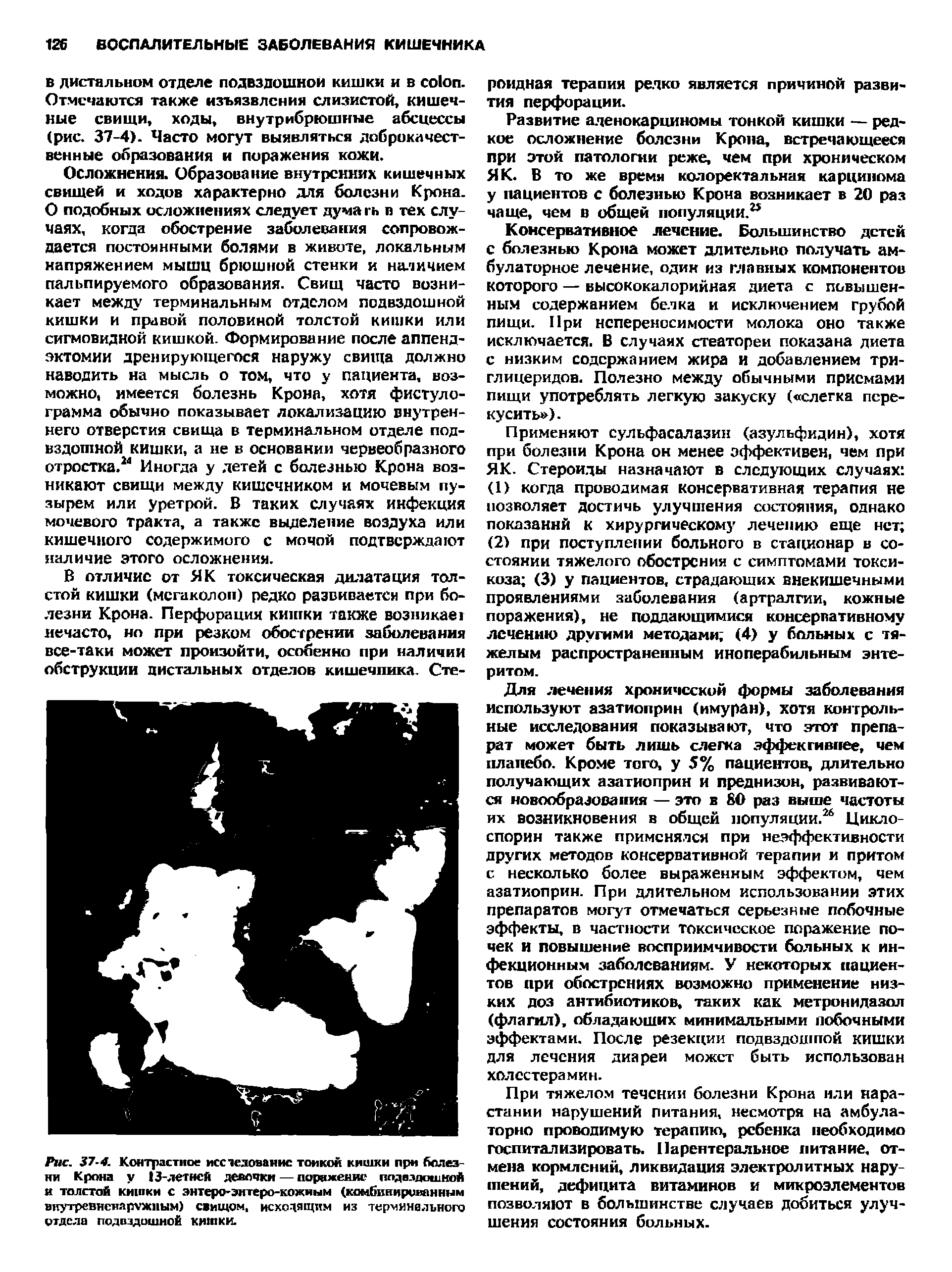 Рис. 37-4. Контрастное исследование тонкой кишки при болезни Крона у 13-летнсй девочки — поражение ппдвздошмой и толстой кишки с энтсро энтеро-кожным (комбинированным внутревненяружпым) свищом, исходящим из терминального отдела подвздошной кишки.