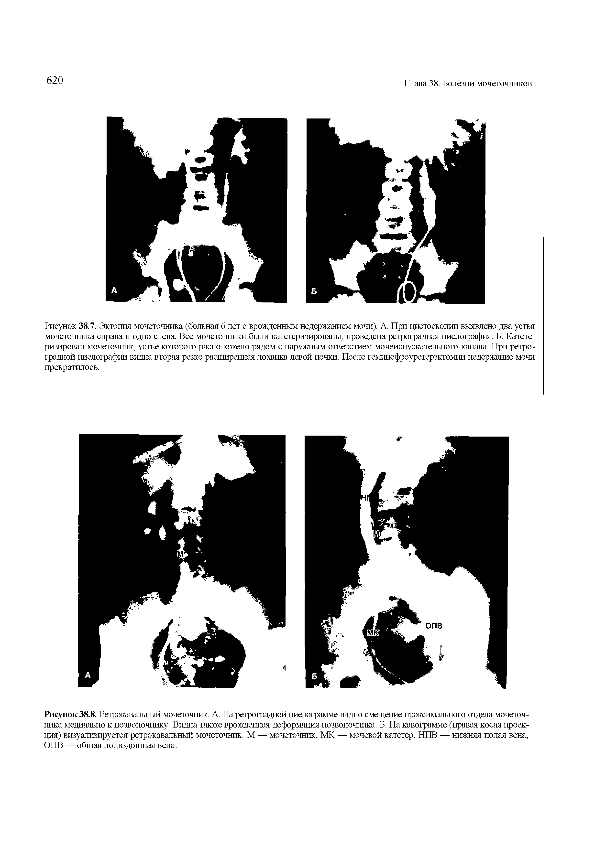 Рисунок 38.8. Ретрокавальный мочеточник. А. На ретроградной пиелограмме видно смещение проксимального отдела мочеточника медиально к позвоночнику. Видна также врожденная деформация позвоночника. Б. На кавограмме (правая косая проекция) визуализируется ретрокавальный мочеточник. М — мочеточник, МК — мочевой катетер, Н11В — нижняя полая вена, ОПВ — общая подвздошная вена.