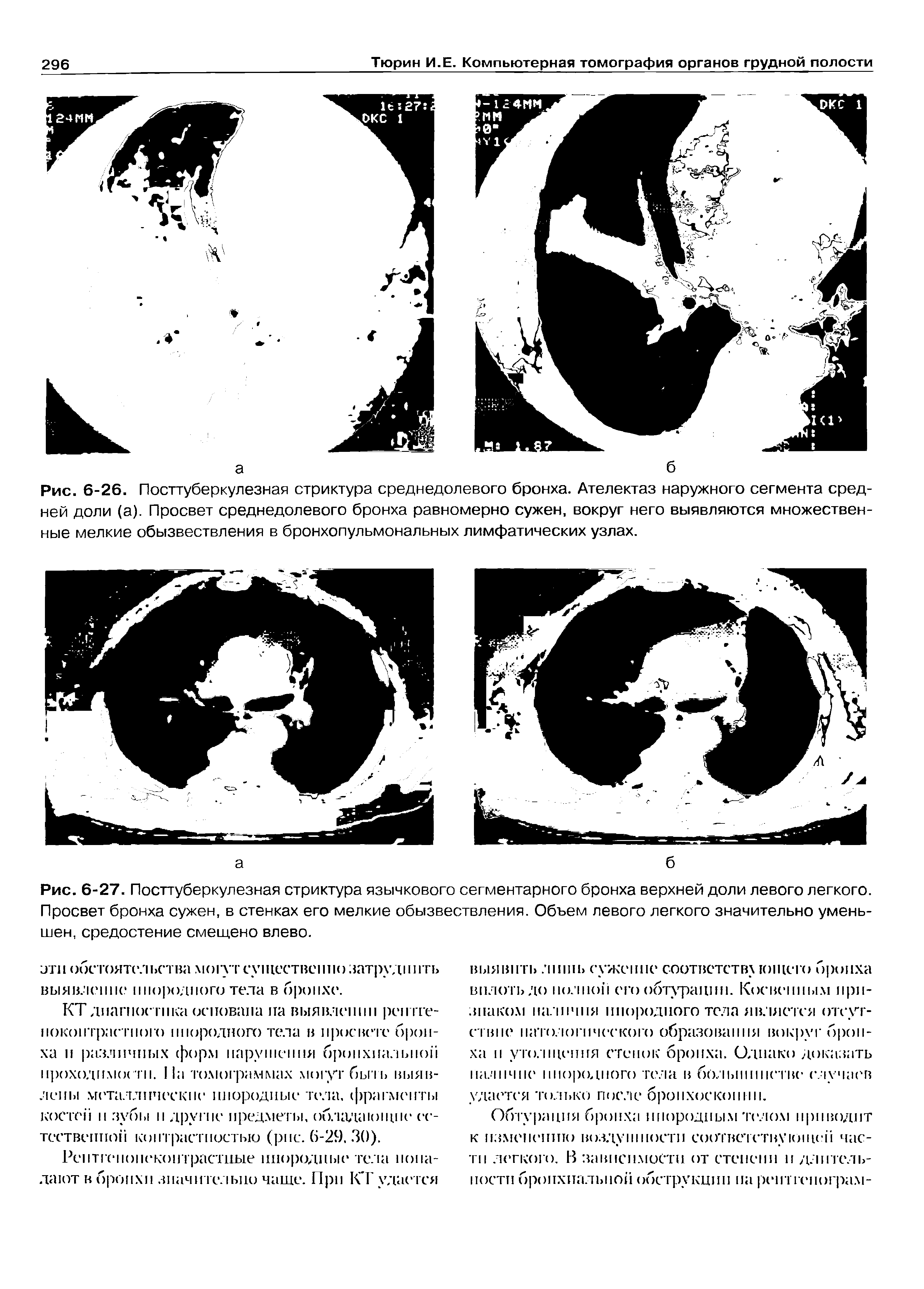 Рис. 6-26. Посттуберкулезная стриктура среднедолевого бронха. Ателектаз наружного сегмента средней доли (а). Просвет среднедолевого бронха равномерно сужен, вокруг него выявляются множественные мелкие обызвествления в бронхопульмональных лимфатических узлах.