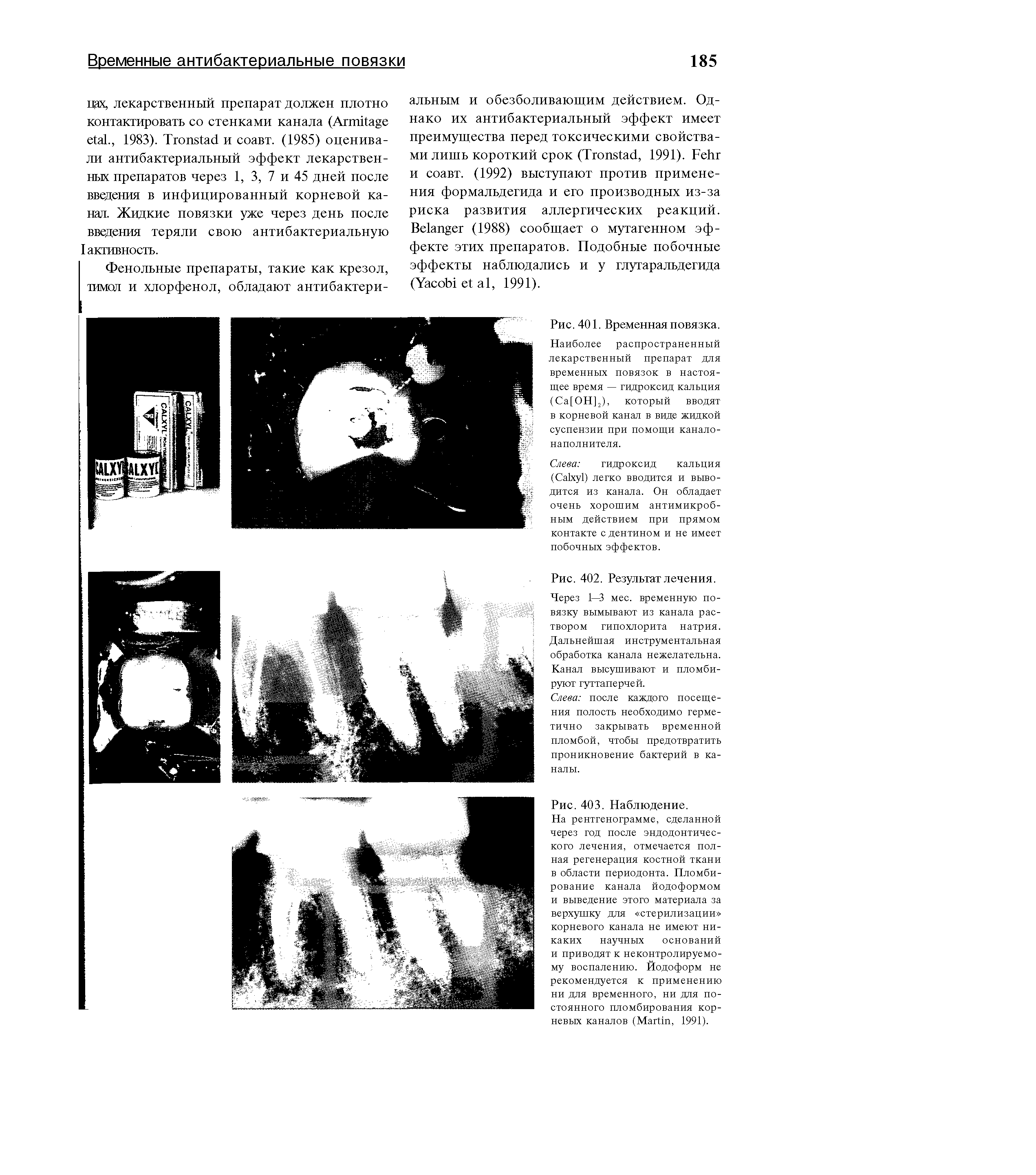 Рис. 401. Временная повязка. Наиболее распространенный лекарственный препарат для временных повязок в настоящее время — гидроксид кальция (Са[ОН]2), который вводят в корневой канал в виде жидкой суспензии при помощи канало-наполнителя.