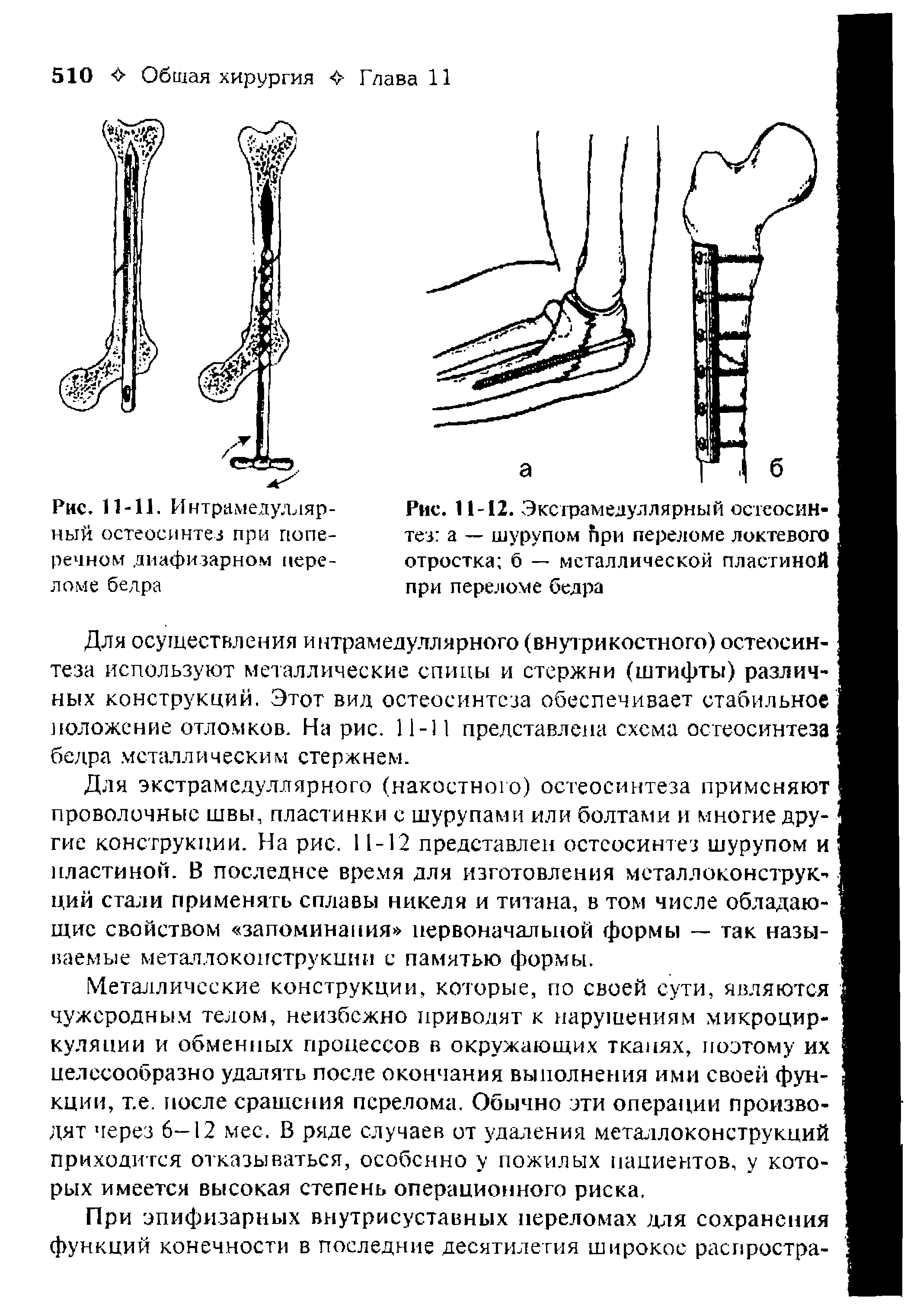 Рис. 11-12. Экстрамедуллярный остеосинтез а — шурупом при переломе локтевого отростка б — металлической пластиной при переломе бедра...