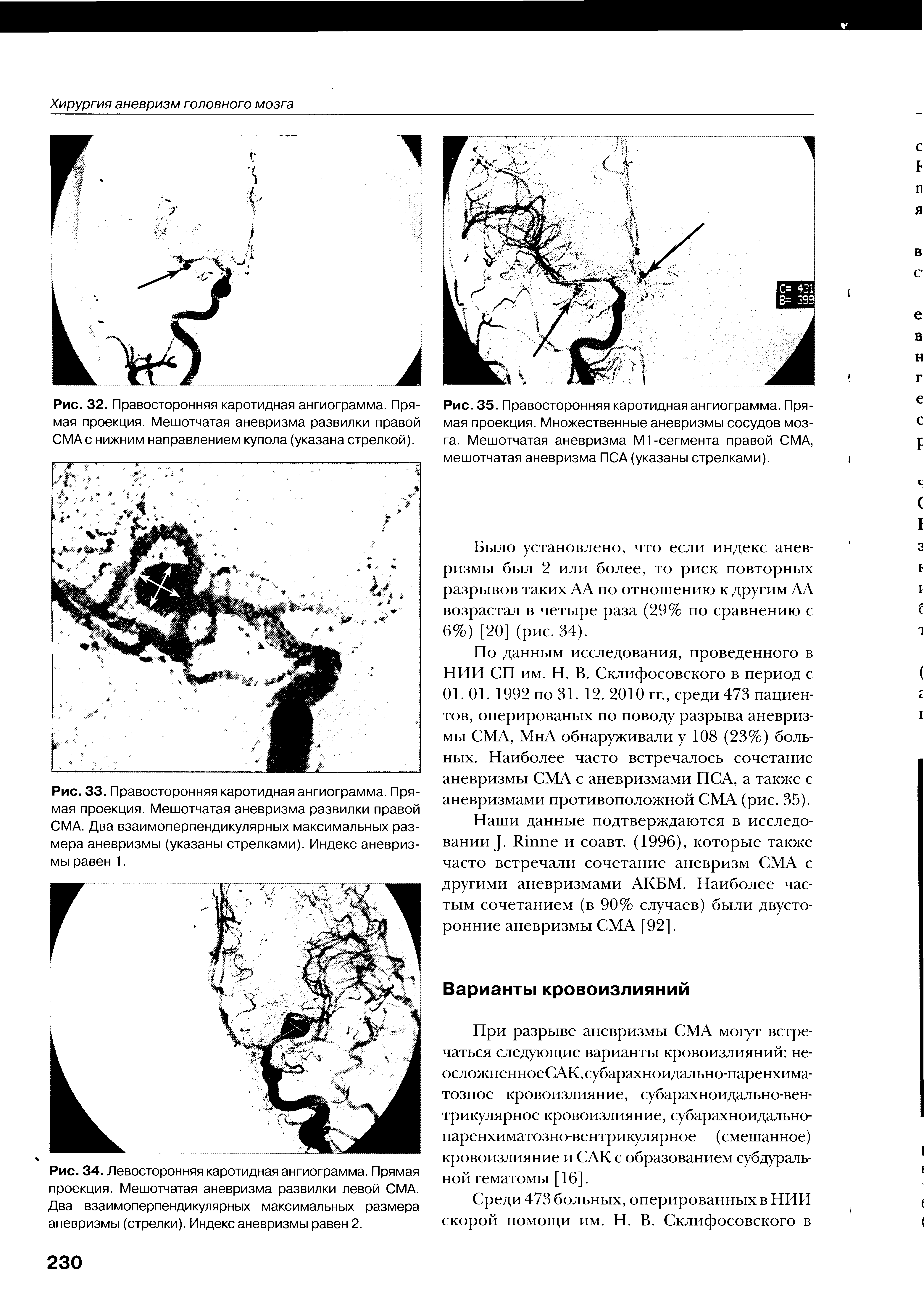 Рис. 35. Правосторонняя каротидная ангиограмма. Прямая проекция. Множественные аневризмы сосудов мозга. Мешотчатая аневризма М1-сегмента правой СМА, мешотчатая аневризма ПСА (указаны стрелками).