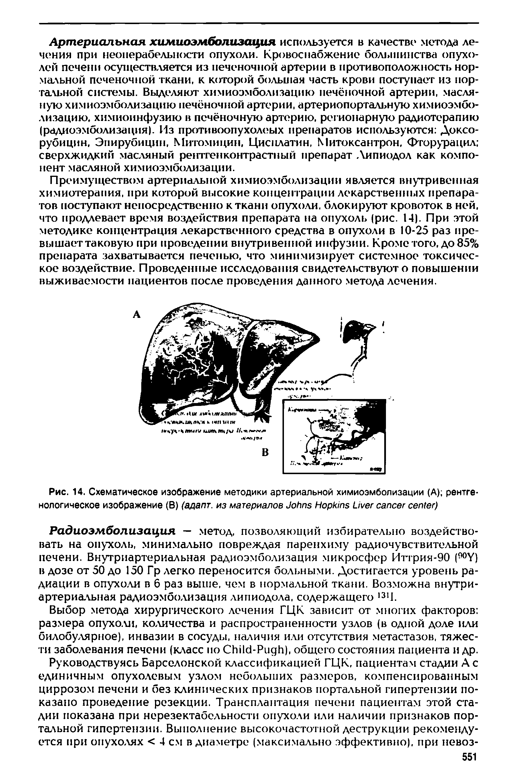 Рис. 14. Схематическое изображение методики артериальной химиоэмболизации (А) рентгенологическое изображение (В) (адапт. из материалов J H L )...