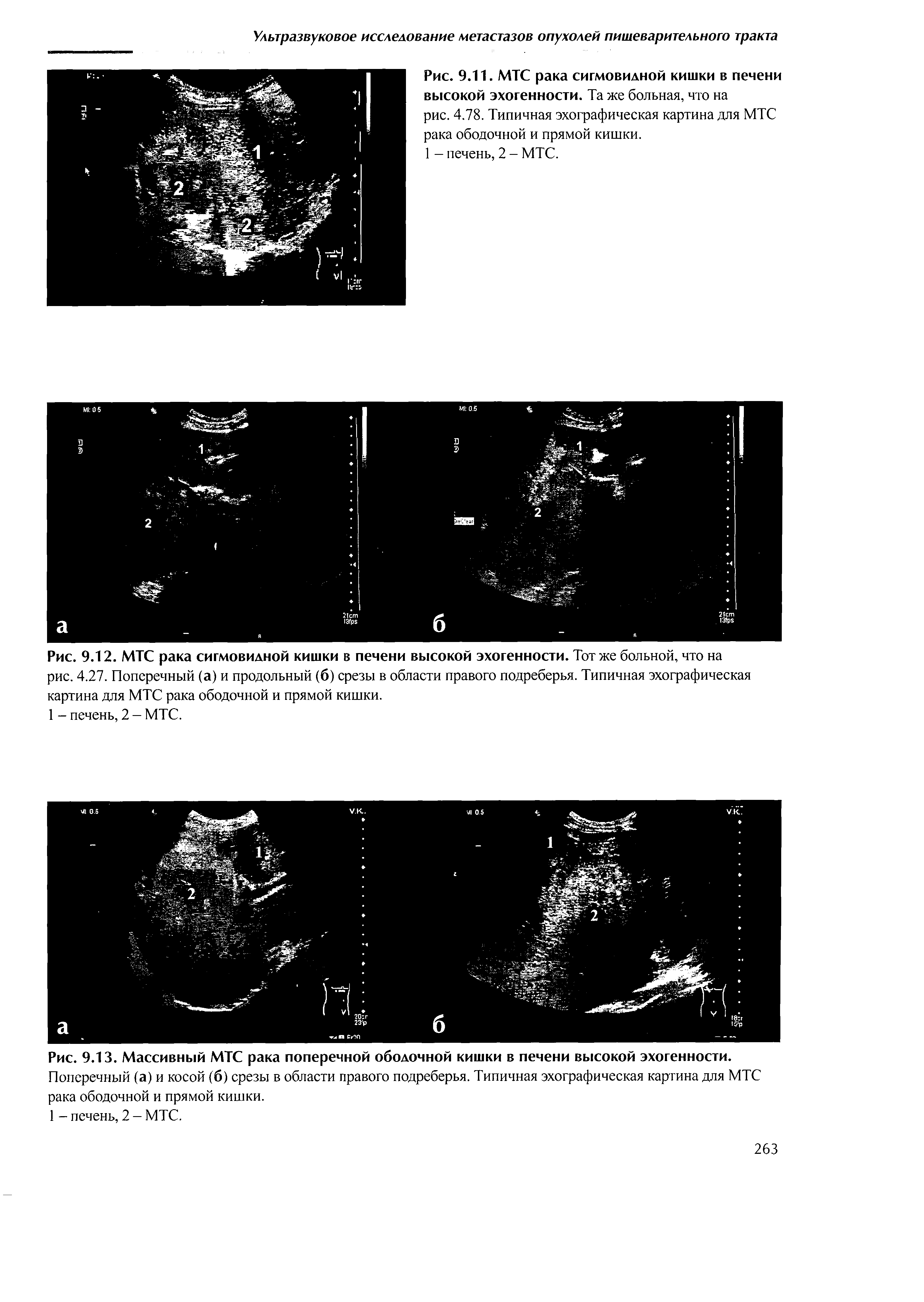 Рис. 9.12. МТС рака сигмовидной кишки в печени высокой эхогенности. Тот же больной, что на рис. 4.27. Поперечный (а) и продольный (б) срезы в области правого подреберья. Типичная эхографическая картина для МТС рака ободочной и прямой кишки.