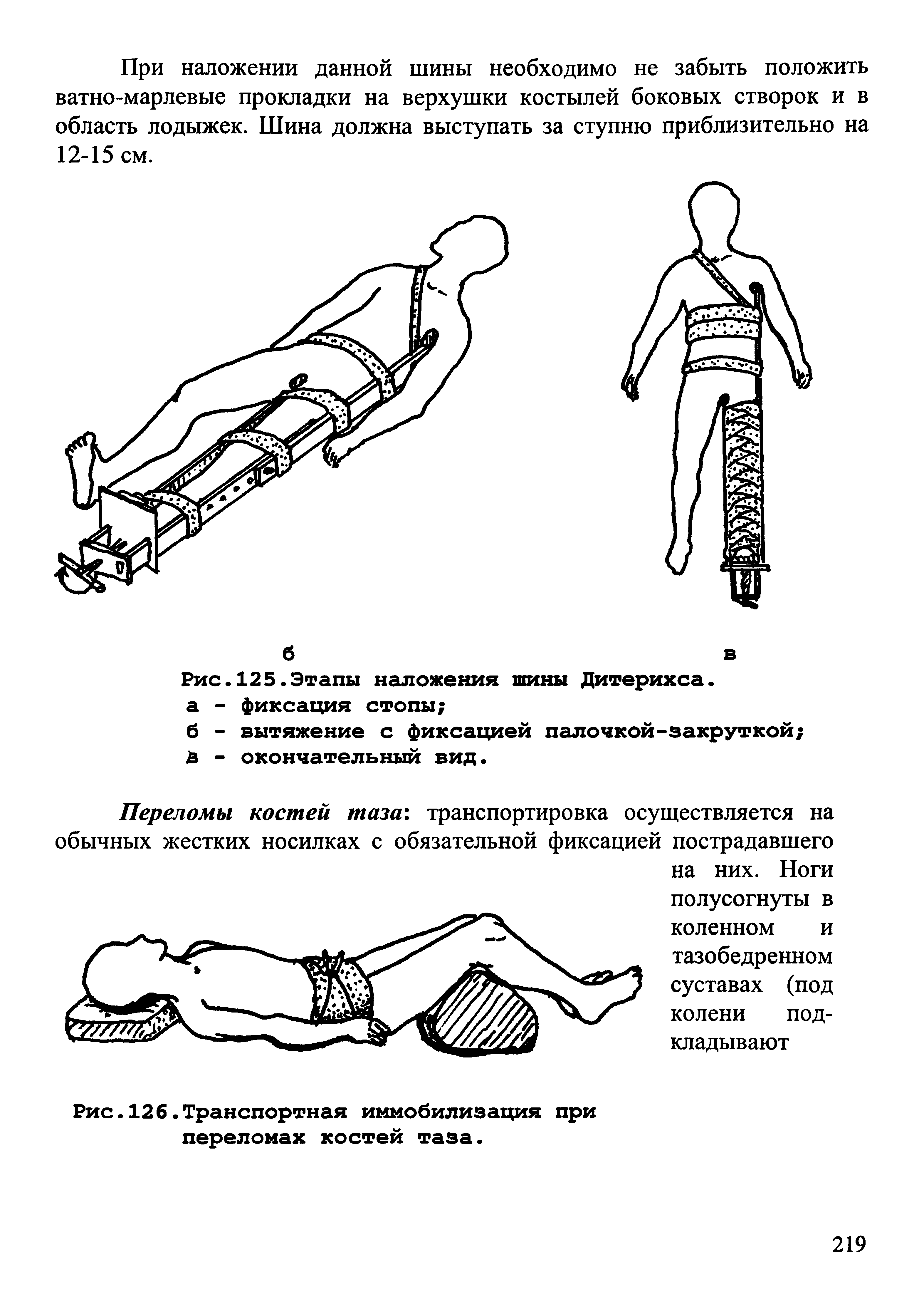 Рис.125.Этапы наложения шины Дитерихса. а - фиксация стопы ...