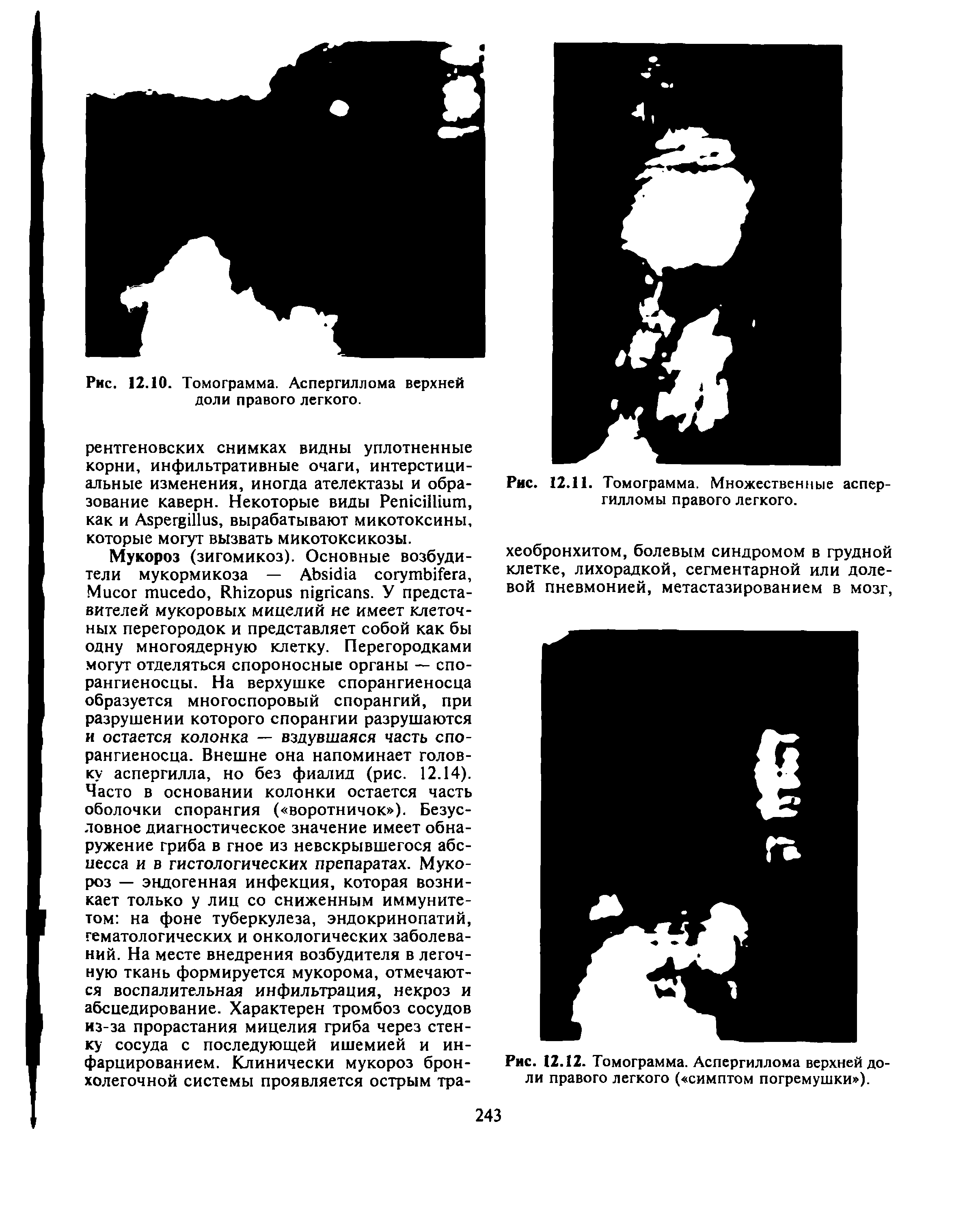 Рис. 12.12. Томограмма. Аспергиллома верхней доли правого легкого ( симптом погремушки ).