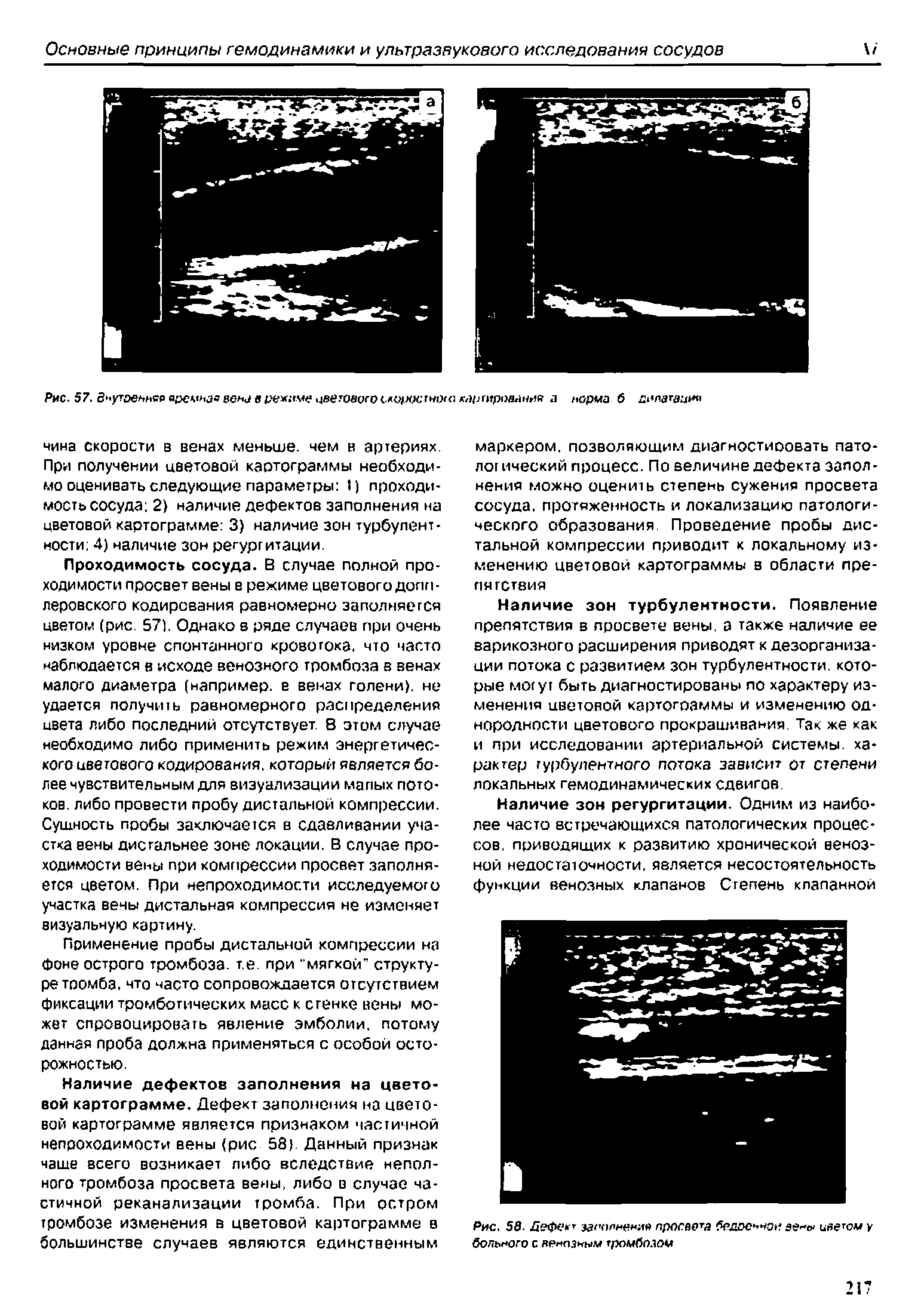 Рис. 58- Дефект доюлявмия просвета бедренной ее цяегсл/ у бО/ТЬНОГО С ЛРнПЗны громбо.юм...