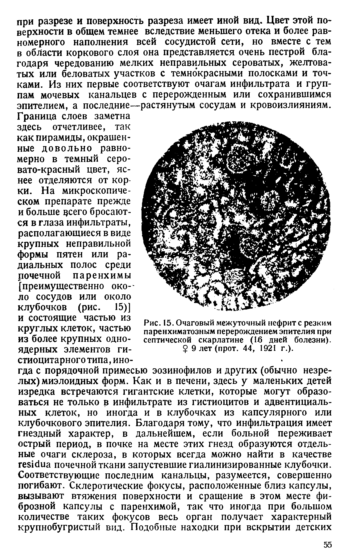 Рис. 15. Очаговый межуточный нефрите резким паренхиматозным перерождением эпителия при септической скарлатине (16 дней болезни). 9 лет (прот. 44, 1921 г.).