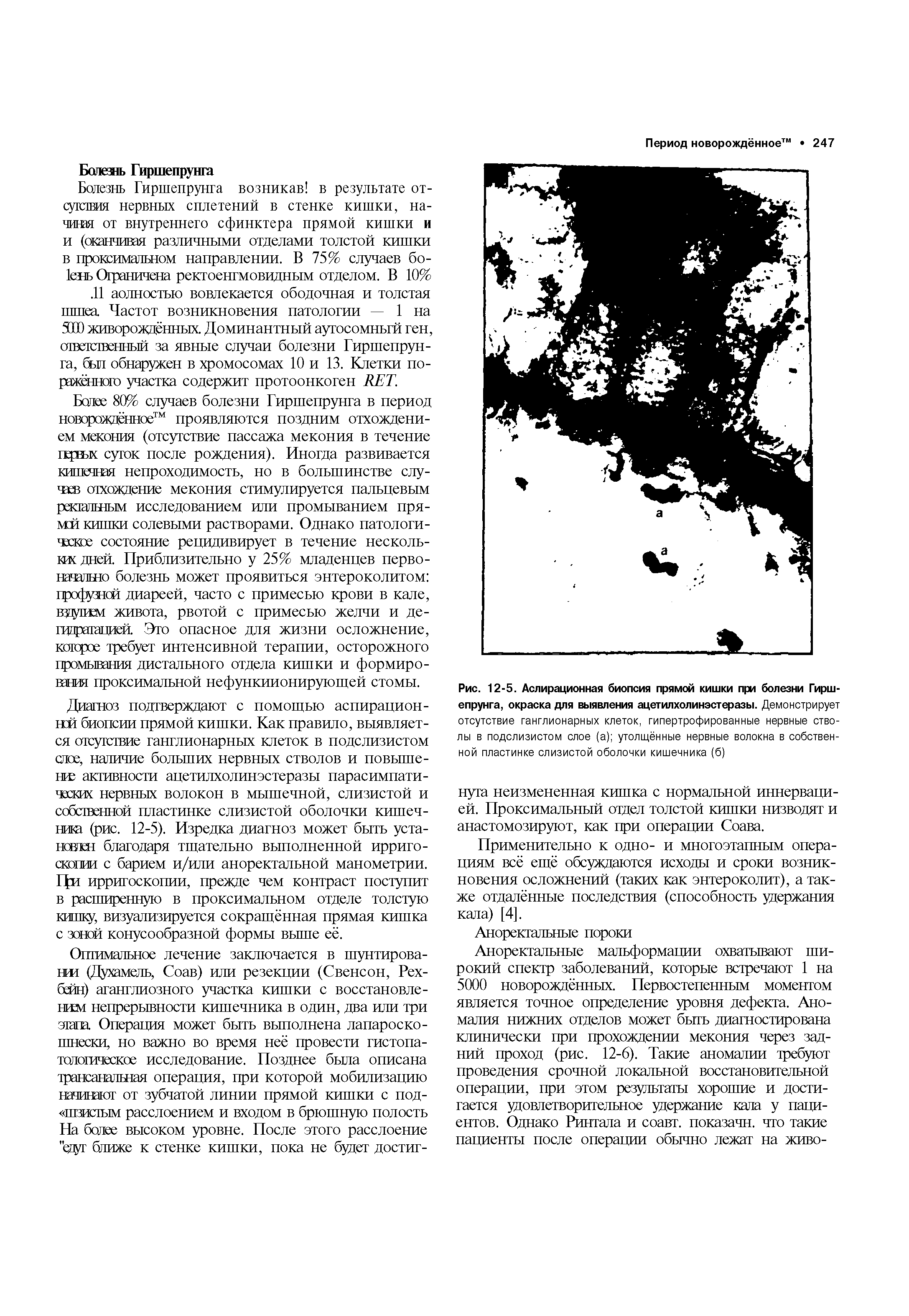 Рис. 12-5. Аспирационная биопсия прямой кишки при болезни Гиршепрунга, окраска для выявления ацетилхолинэстеразы. Демонстрирует отсутствие ганглионарных клеток, гипертрофированные нервные стволы в подслизистом слое (а) утолщённые нервные волокна в собственной пластинке слизистой оболочки кишечника (б)...