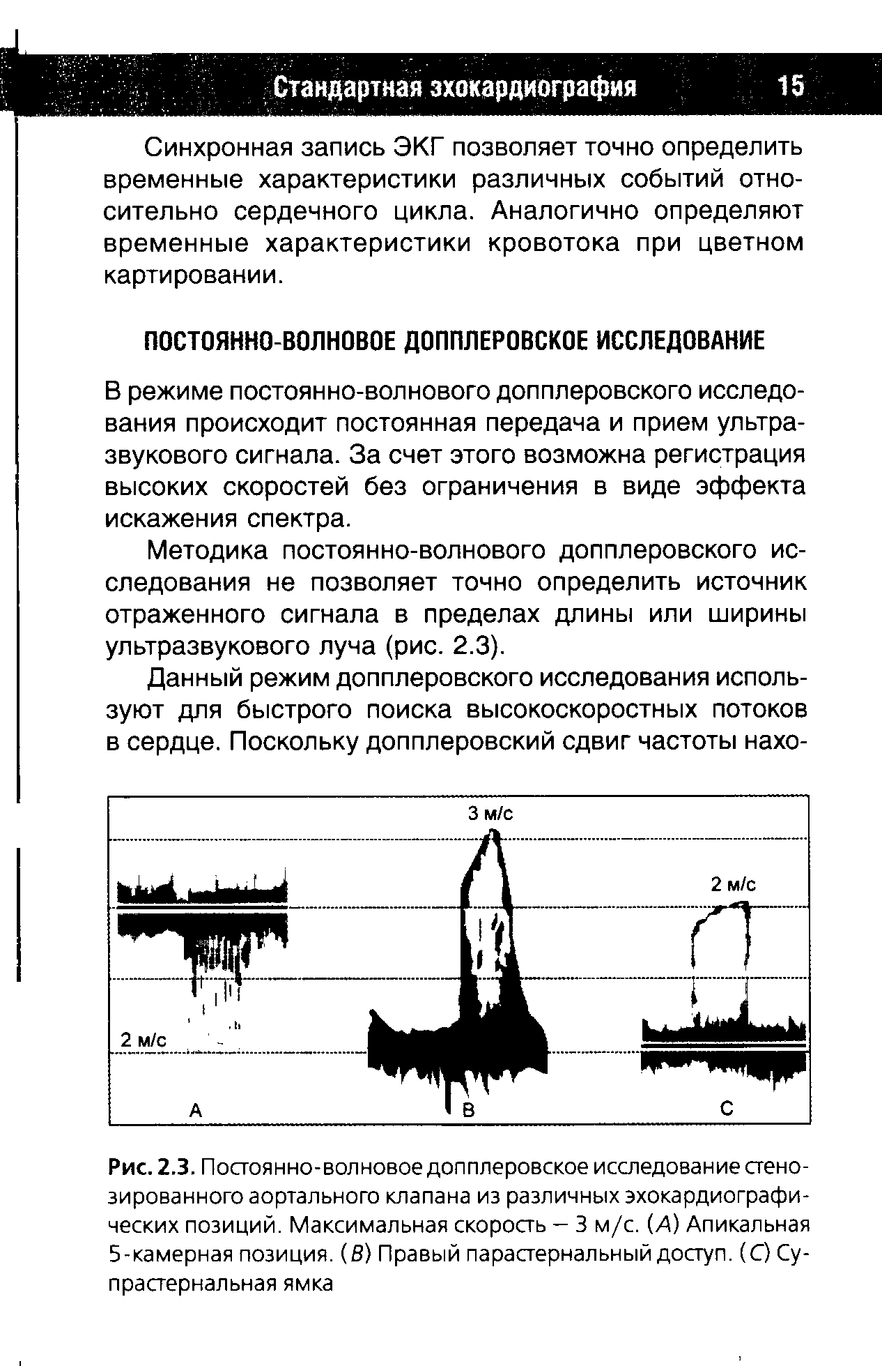 Рис. 2.3. Постоянно-волновое допплеровское исследование стенозированного аортального клапана из различных эхокардиографических позиций. Максимальная скорость - 3 м/с. (А) Апикальная 5-камерная позиция. (8) Правый парастернальный доступ. (С) Су-прастернальная ямка...