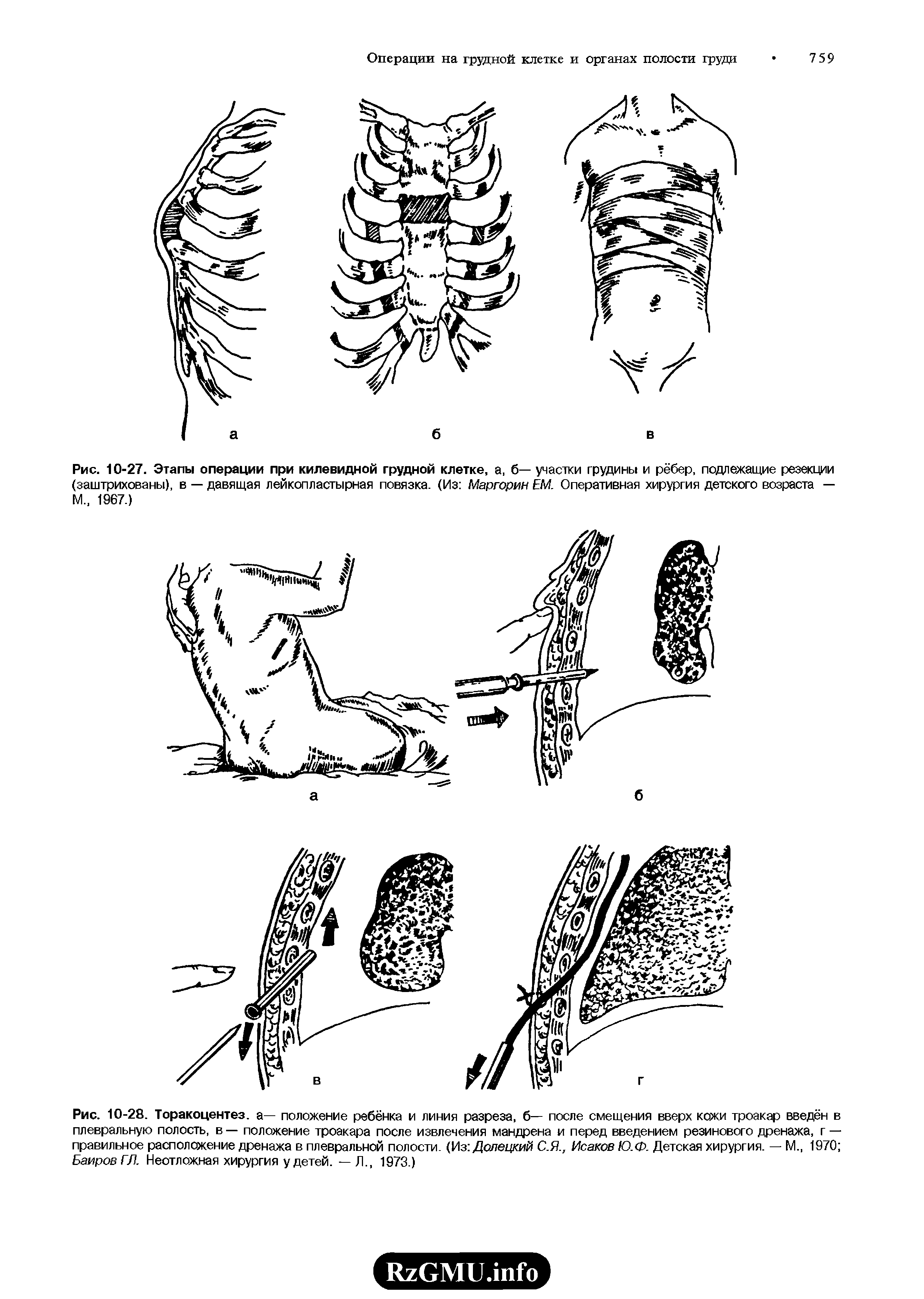 Рис. 10-28. Торакоцентез. а— положение ребёнка и линия разреза, б— после смещения вверх кожи троакар введён в плевральную полость, в — положение троакара после извлечения мандрена и перед введением резинового дренажа, г — правильное расположение дренажа в плевральной полости. (Из Долецкий С.Я., Исаков Ю.Ф. Детская хирургия. — М., 1970 БаировГЛ. Неотложная хирургия у детей. — Л., 1973.)...