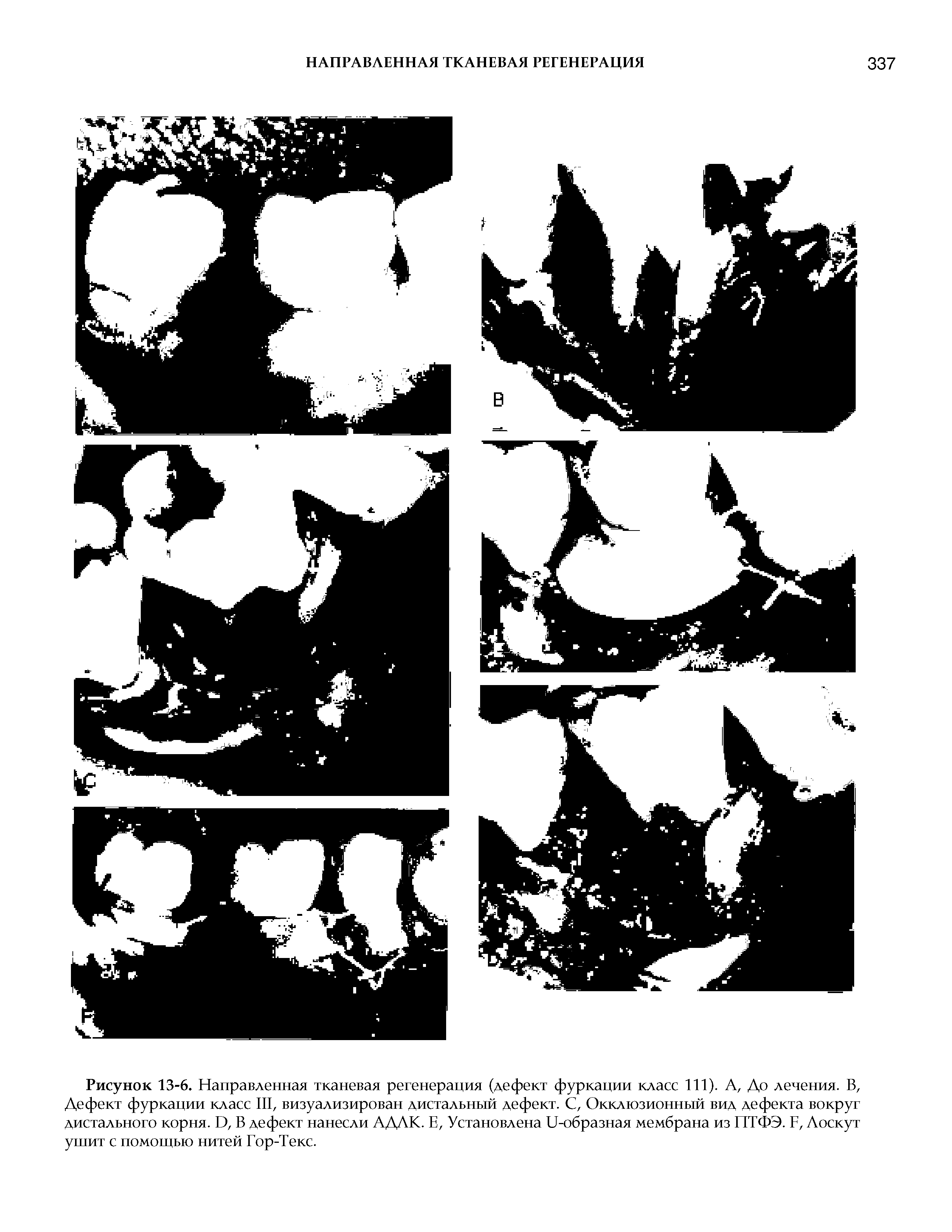 Рисунок 13-6. Направленная тканевая регенерация (дефект фуркации класс 111). А, До лечения. В, Дефект фуркации класс III, визуализирован дистальный дефект. С, Окклюзионный вид дефекта вокруг дистального корня. I ), В дефект нанесли АДАК. Е, Установлена И-образная мембрана из ПТФЭ. , Лоскут ушит с помощью нитей Гор-Текс.