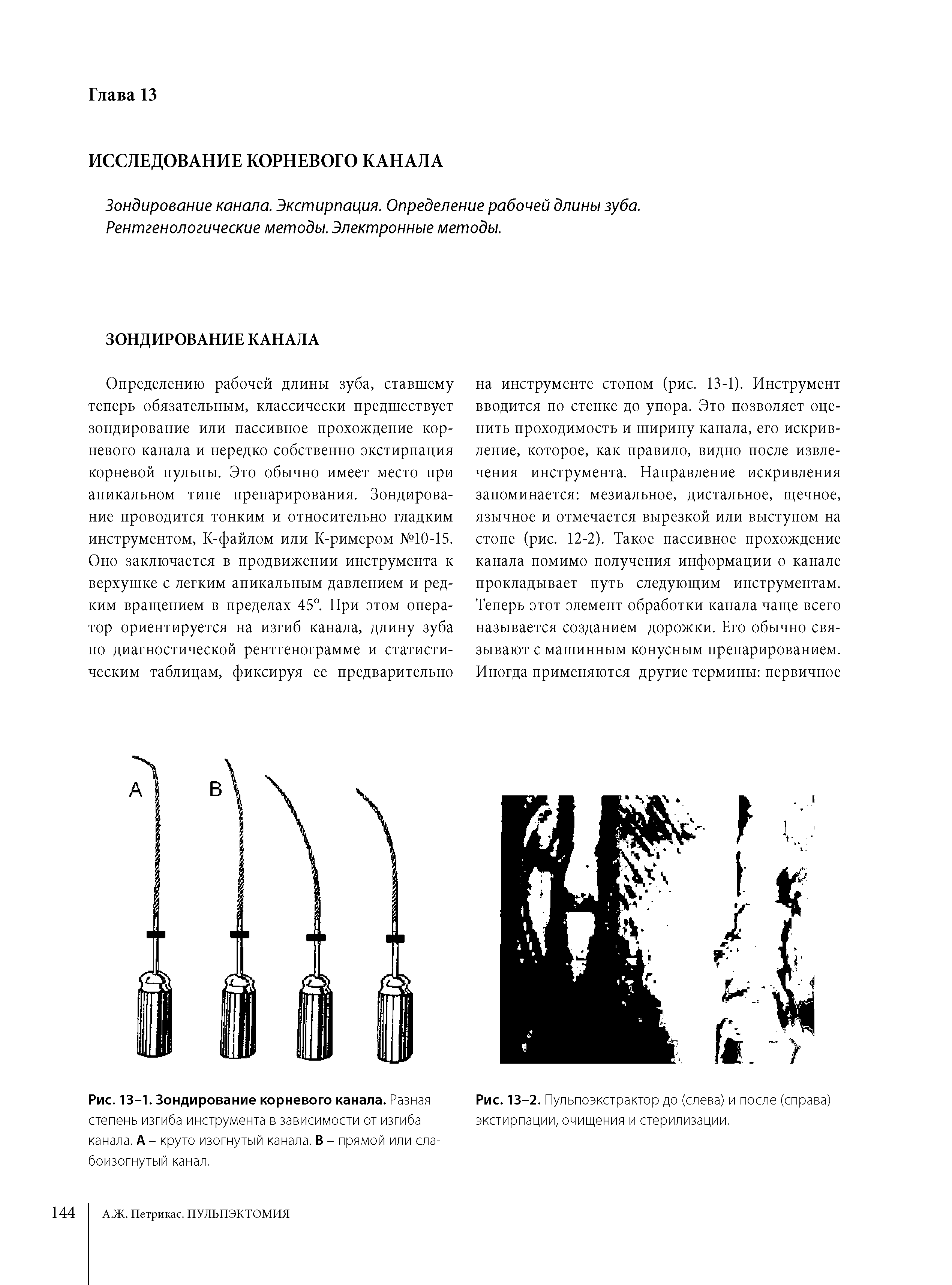 Рис. 13-1. Зондирование корневого канала. Разная степень изгиба инструмента в зависимости от изгиба канала. А - круто изогнутый канала. В - прямой или слабоизогнутый канал.