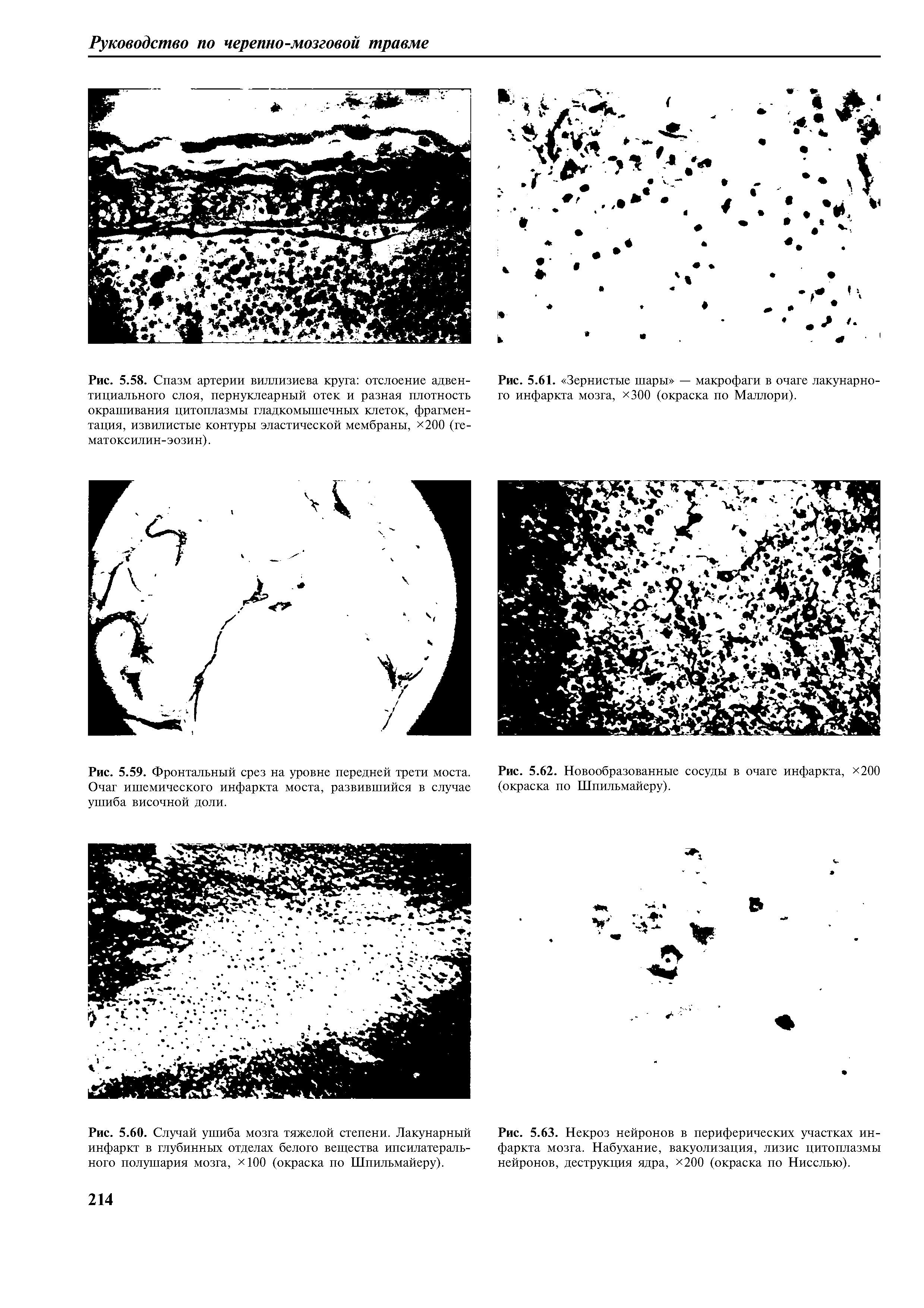 Рис. 5.59. Фронтальный срез на уровне передней трети моста. Очаг ишемического инфаркта моста, развившийся в случае ушиба височной доли.