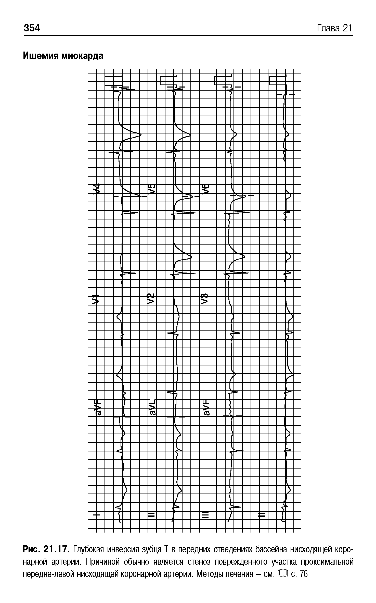 Рис. 21.17. Глубокая инверсия зубца Т в передних отведениях бассейна нисходящей коронарной артерии. Причиной обычно является стеноз поврежденного участка проксимальной передне-левой нисходящей коронарной артерии. Методы лечения - см. Ш с. 76...
