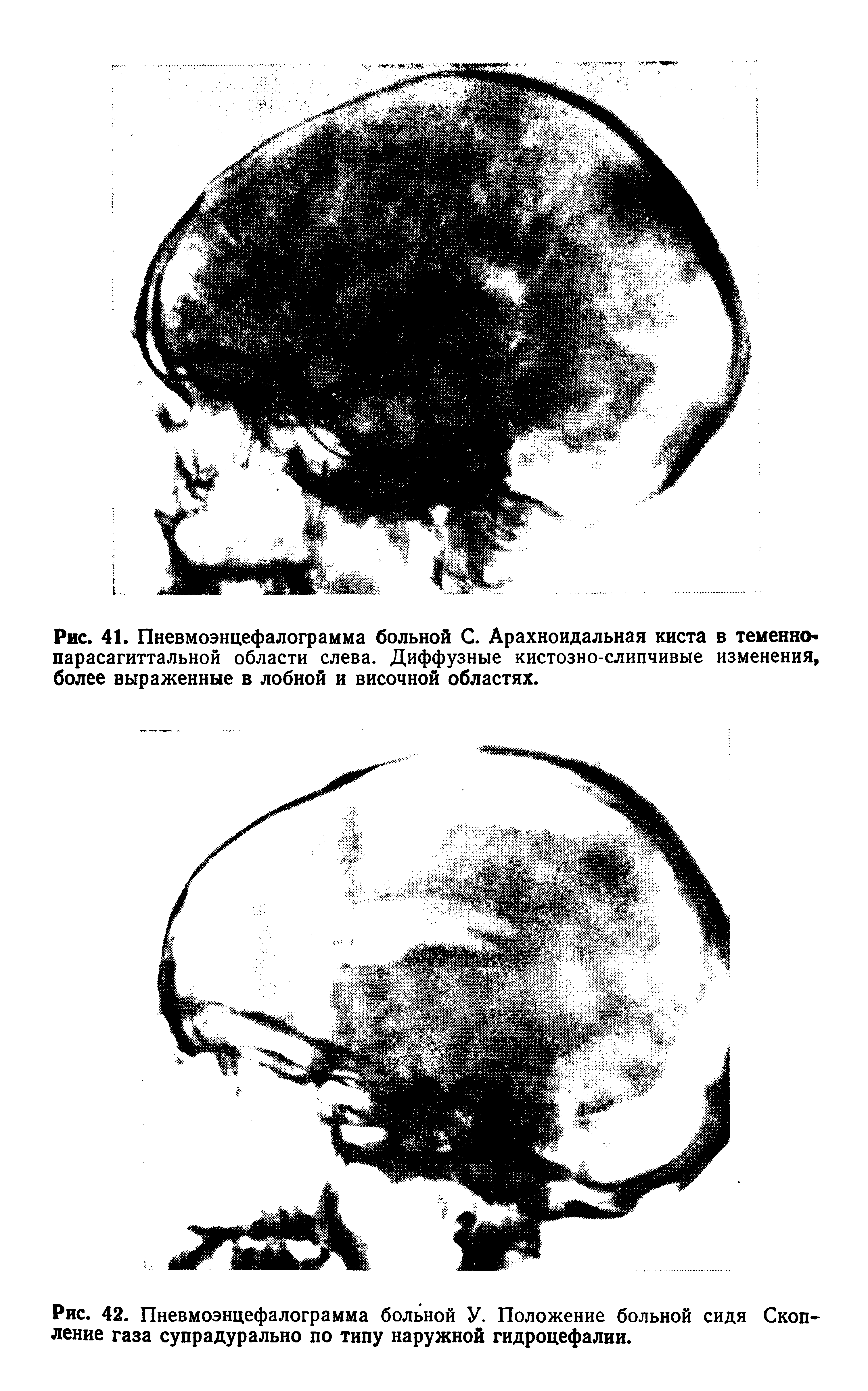 Рис. 42. Пневмоэнцефалограмма больной У. Положение больной сидя Скопление газа супрадурально по типу наружной гидроцефалии.