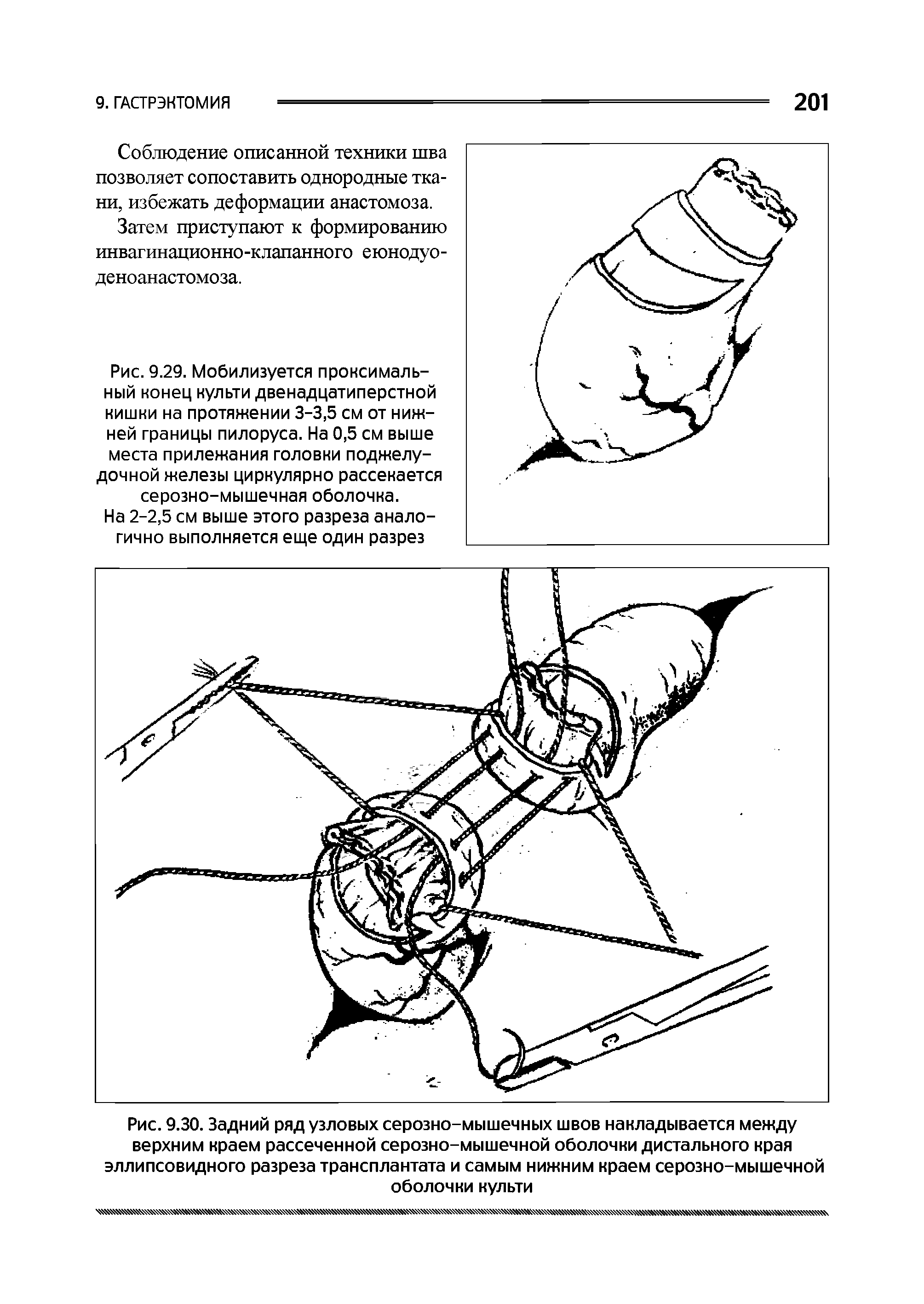 Рис. 9.29. Мобилизуется проксимальный конец культи двенадцатиперстной кишки на протяжении 3-3,5 см от нижней границы пилоруса. На 0,5 см выше места прилежания головки поджелудочной железы циркулярно рассекается серозно-мышечная оболочка.