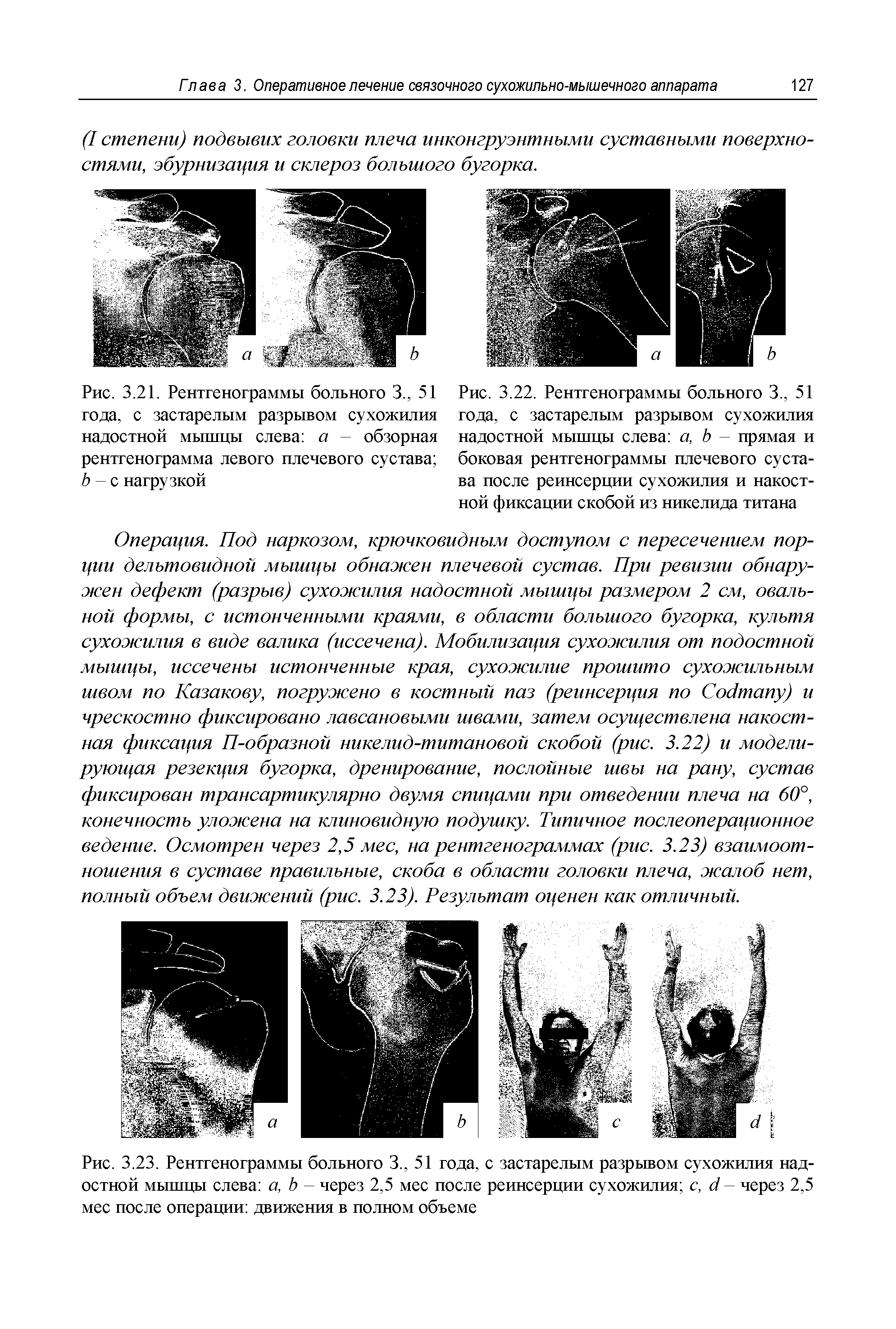 Рис. 3.22. Рентгенограммы больного 3., 51 года, с застарелым разрывом сухожилия надостной мышцы слева а, Ь — прямая и боковая рентгенограммы плечевого сустава после реинсерции сухожилия и накостной фиксации скобой из никелида титана...