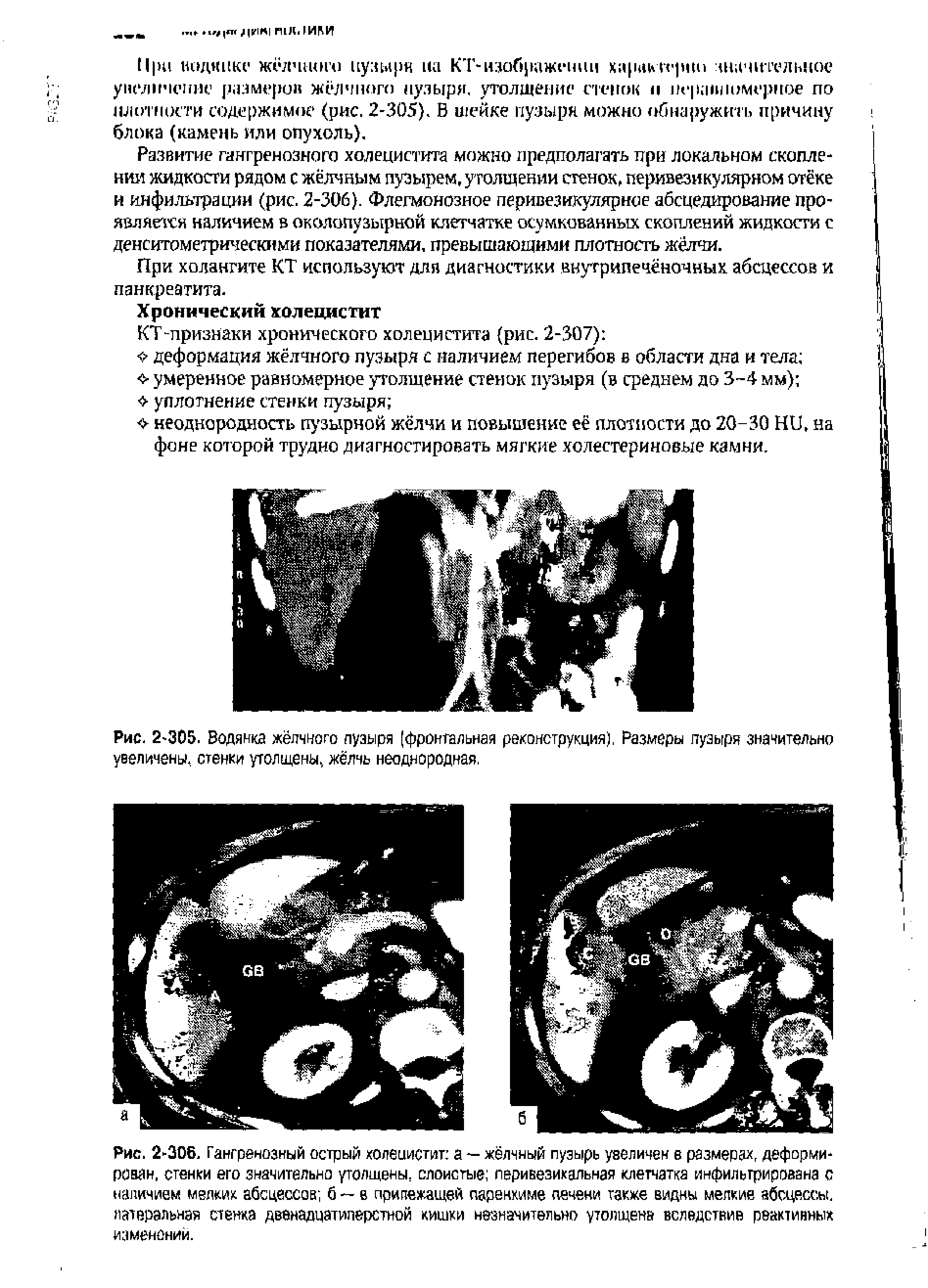 Рис. 2-305. Водянка жёлчного пузыря [фронтальная реконструкция), Размеры пузыря значительно увеличены, стенки утолщены, жёлчь неоднородная,...