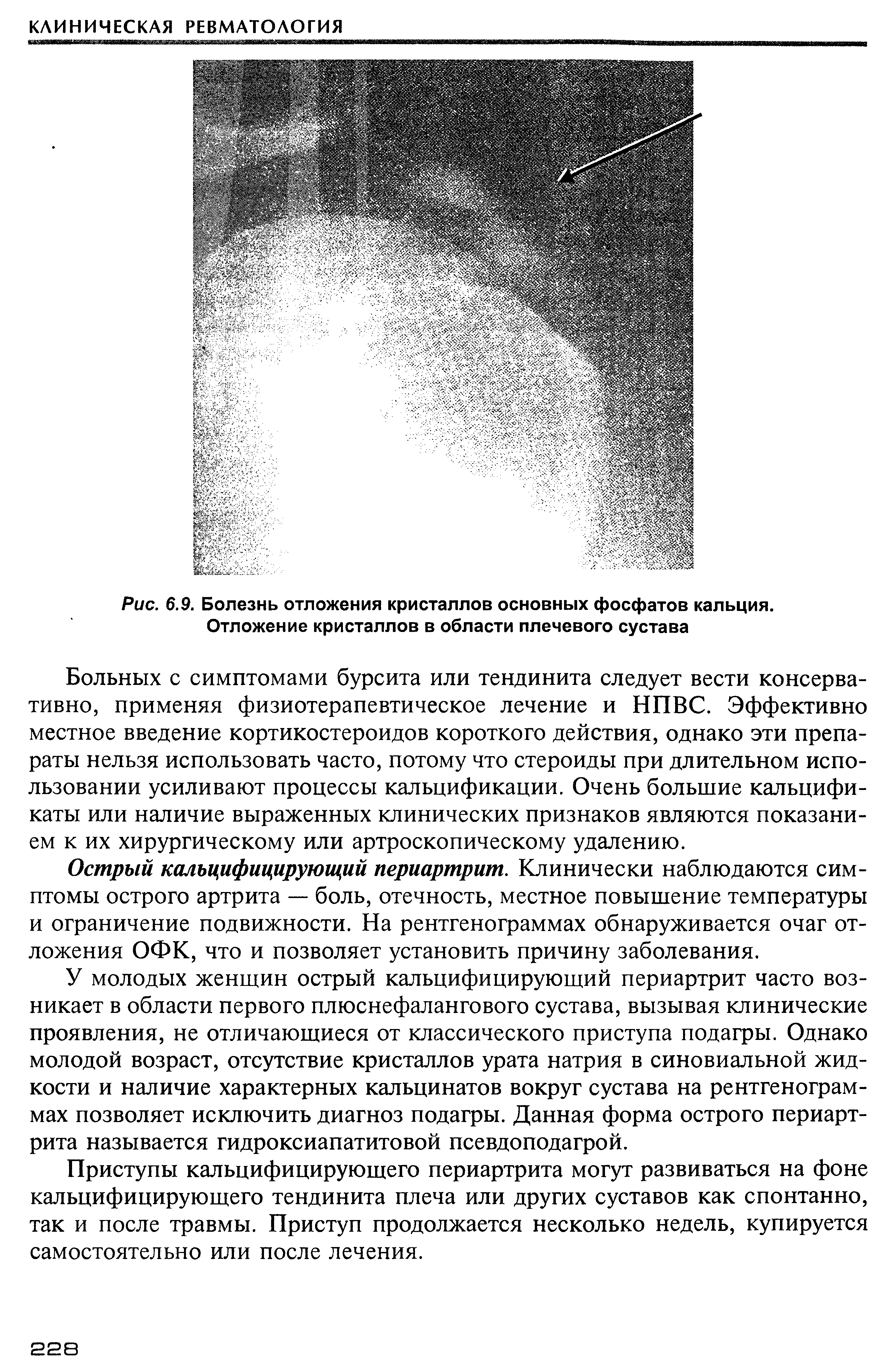 Рис. 6.9. Болезнь отложения кристаллов основных фосфатов кальция. Отложение кристаллов в области плечевого сустава...