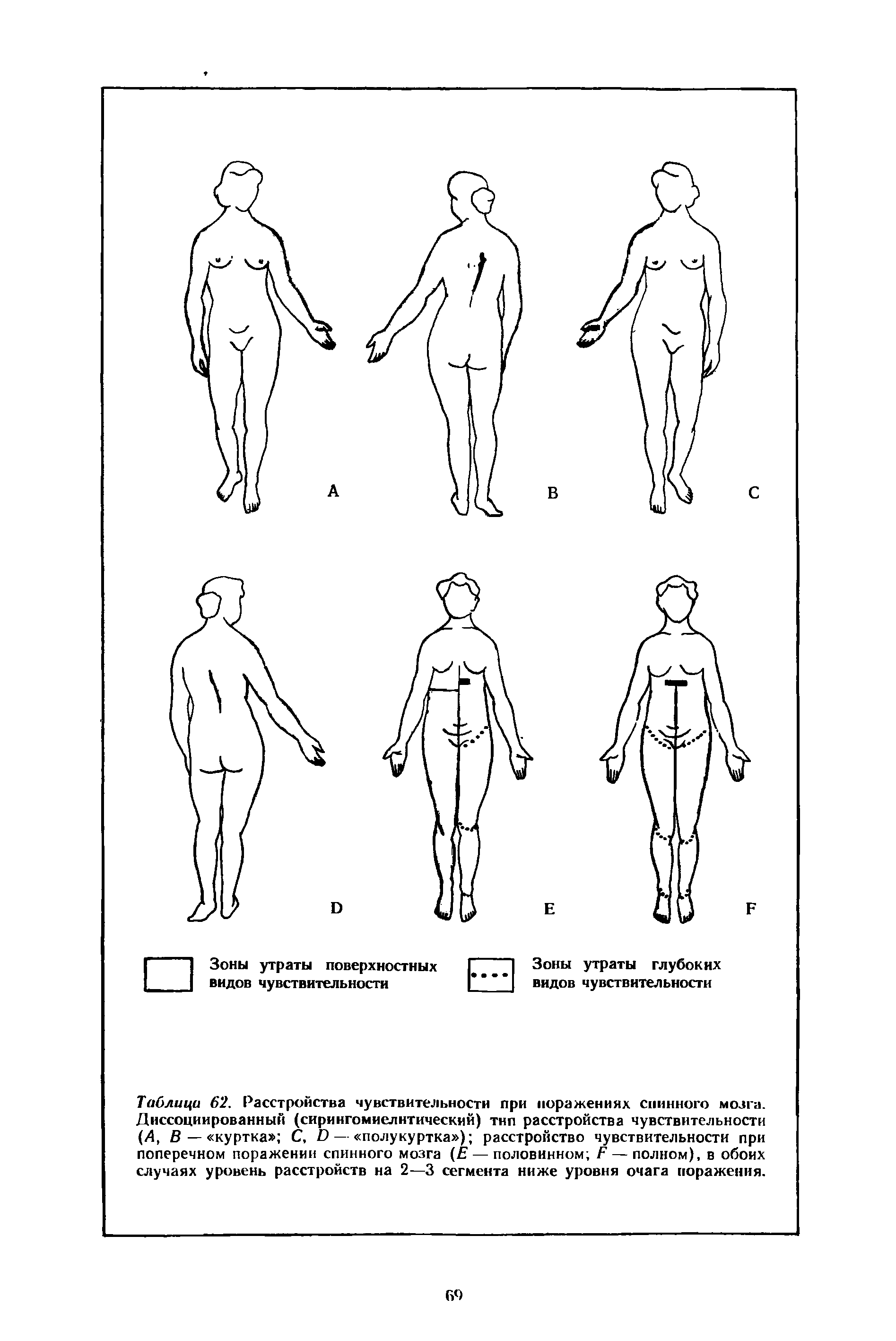 Таблица 62. Расстройства чувствительности при поражениях спинного мозга. Диссоциированный (сирингомиелитический) тип расстройства чувствительности (Л, В— куртка С, О— полукуртка ) расстройство чувствительности при поперечном поражении спинного мозга (Е — половинном Г — полном), в обоих случаях уровень расстройств на 2—3 сегмента ниже уровня очага поражения.