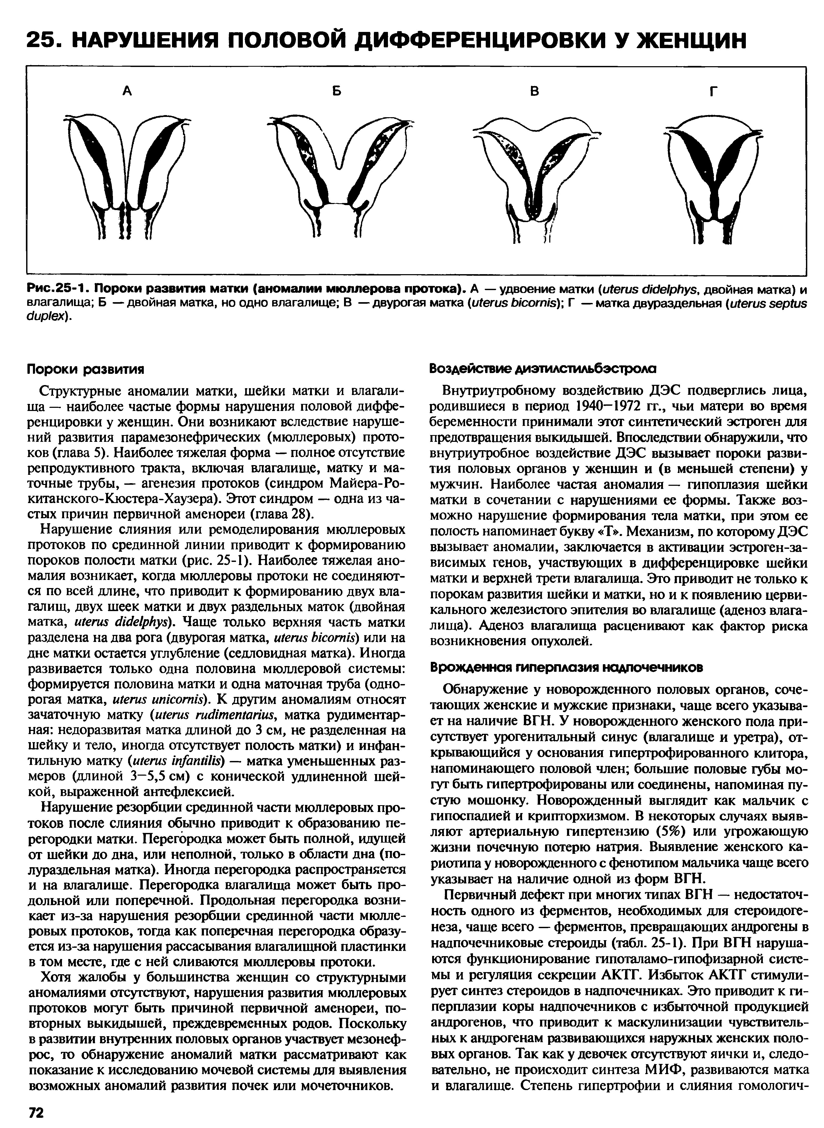 Рис.25-1. Пороки развития матки (аномалии мюллерова протока). А — удвоение матки ( , двойная матка) и влагалища Б — двойная матка, но одно влагалище В — двурогая матка ( )-, Г — матка двураздельная ( ).