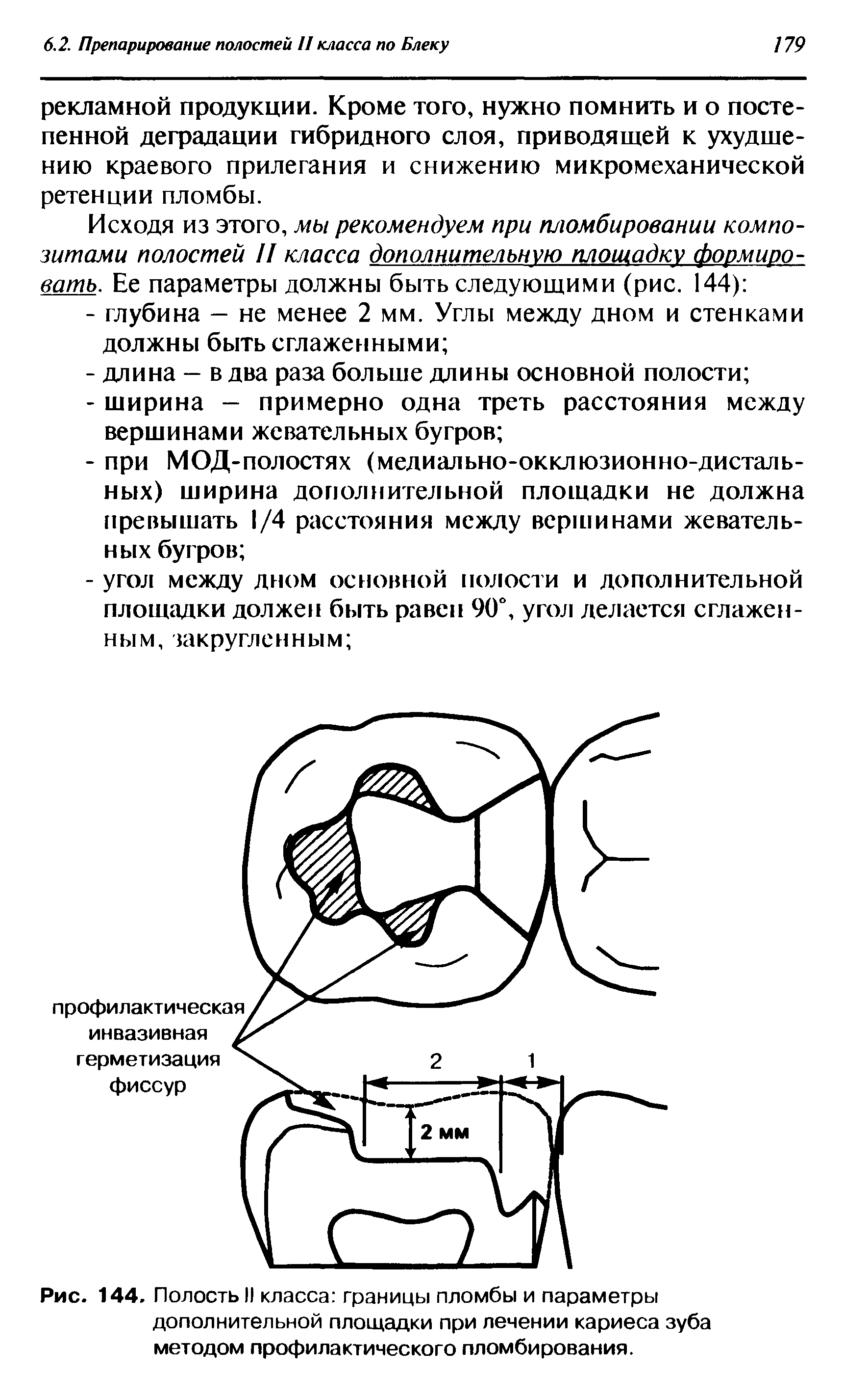 Рис. 144, Полость II класса границы пломбы и параметры дополнительной площадки при лечении кариеса зуба методом профилактического пломбирования.