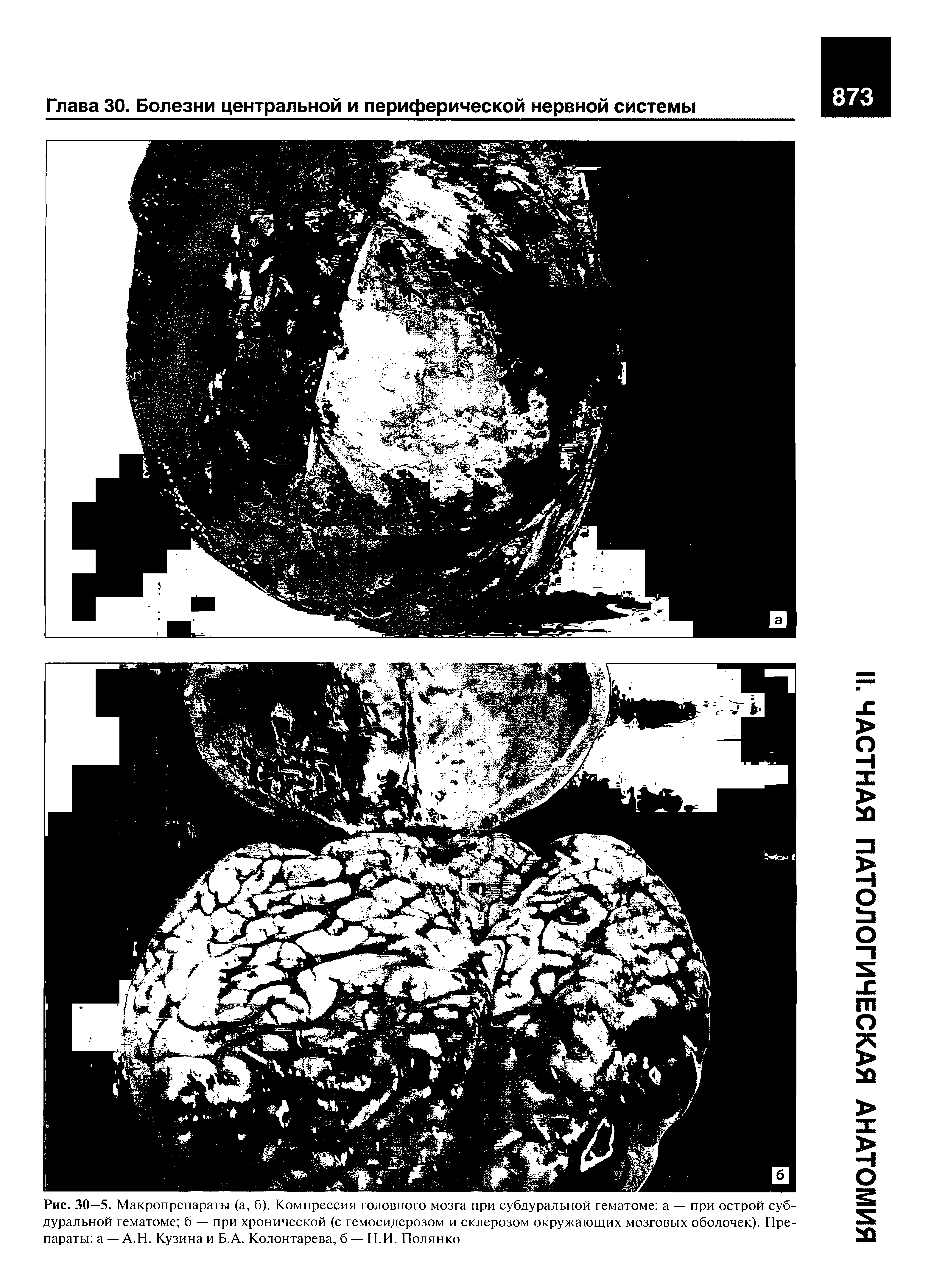 Рис. 30—5. Макропрепараты (а, б). Компрессия головного мозга при субдуральной гематоме а — при острой субдуральной гематоме б — при хронической (с гемосидерозом и склерозом окружающих мозговых оболочек). Препараты а — А.Н. Кузина и Б.А. Колонтарева, б — Н.И. Полянко...