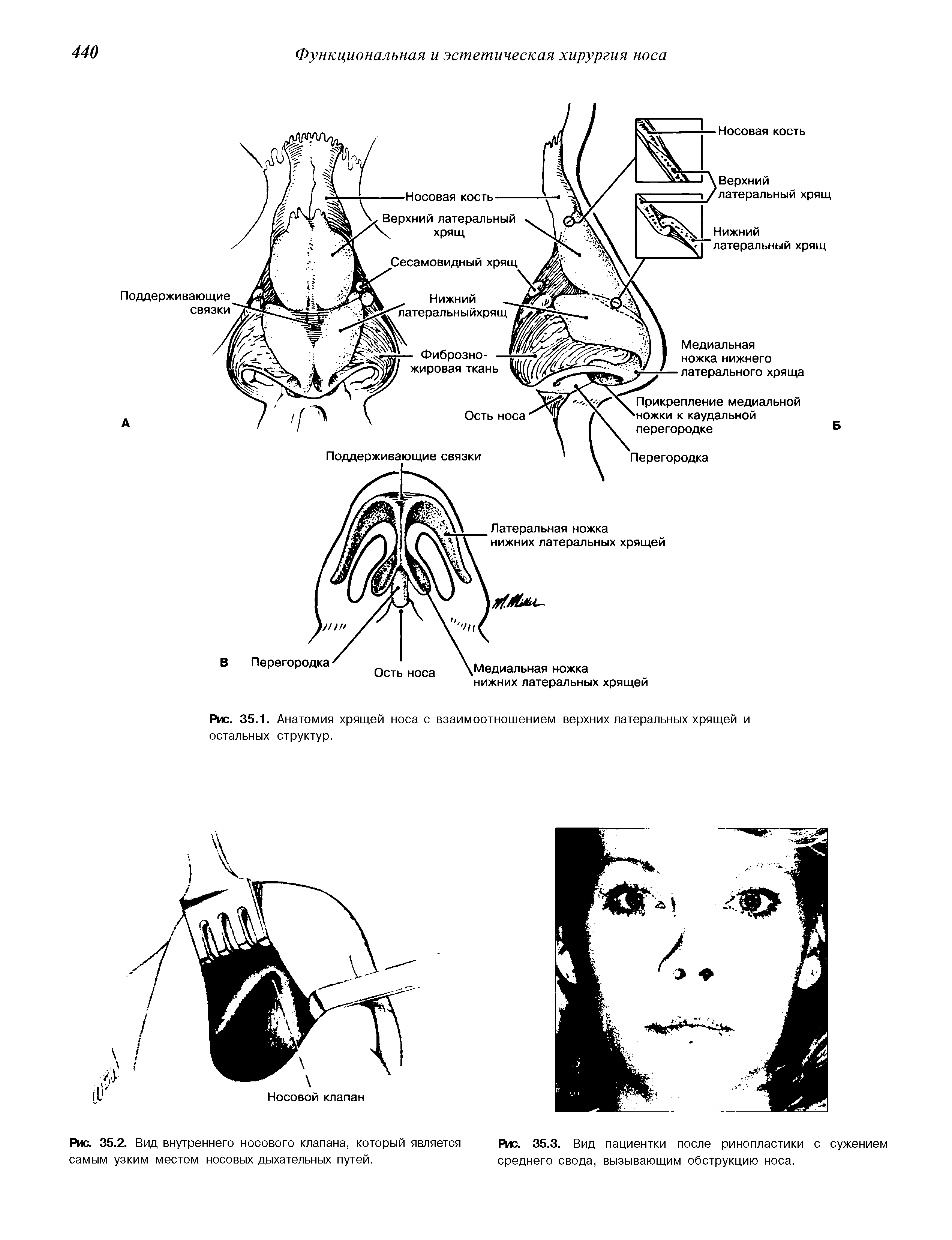 Рис. 35.1. Анатомия хрящей носа с взаимоотношением верхних латеральных хрящей и...