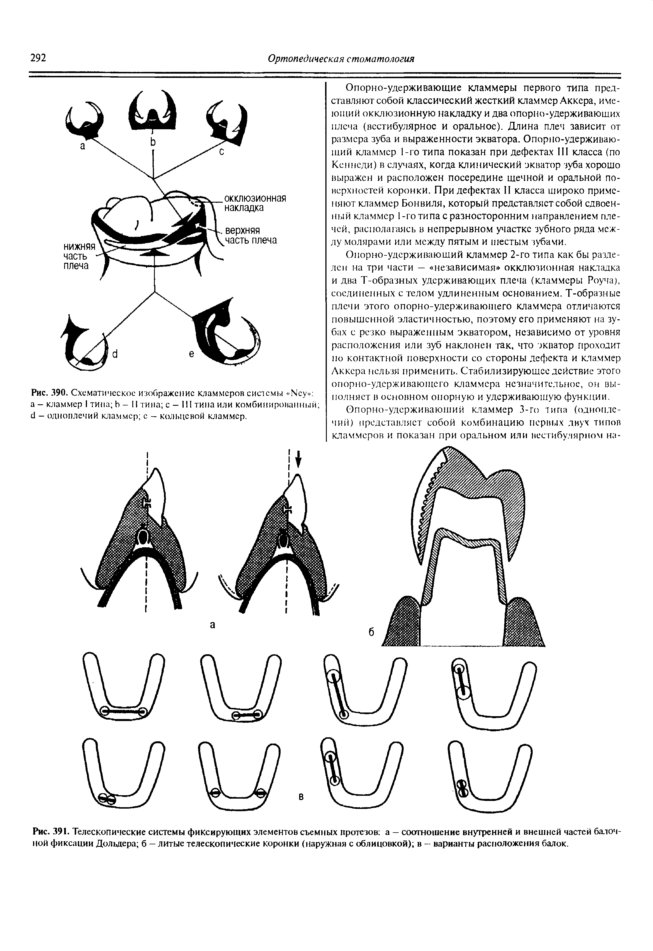 Рис. 391. Телескопические системы фиксирующих элементов съемных протезов а - соотношение внутренней и внешней частей балочной фиксации Дольдера б — литые телескопические коронки (наружная с облицовкой) в — варианты расположения балок.