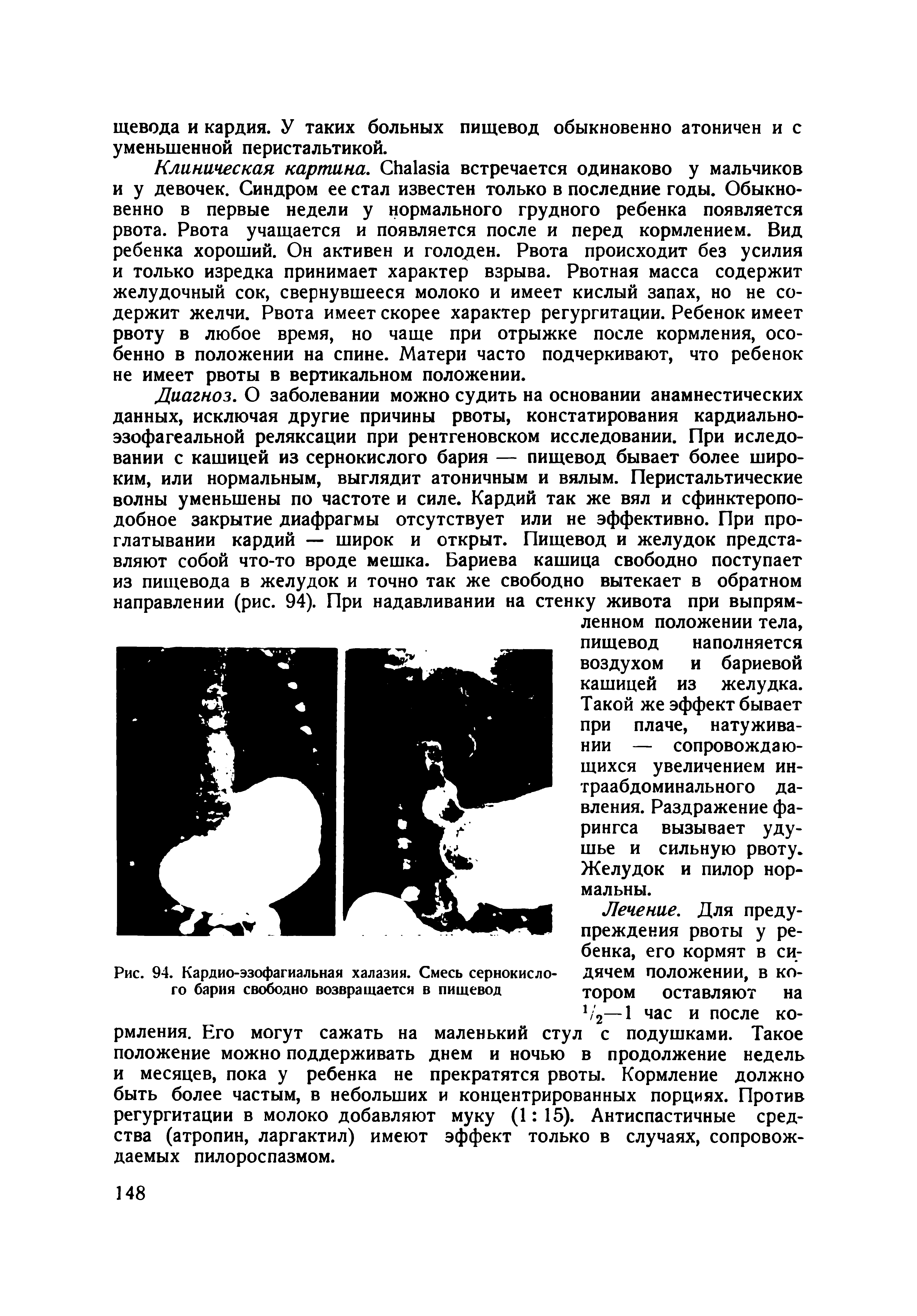 Рис. 94. Кардио-эзофагиальная халазия. Смесь сернокислого бария свободно возвращается в пищевод...