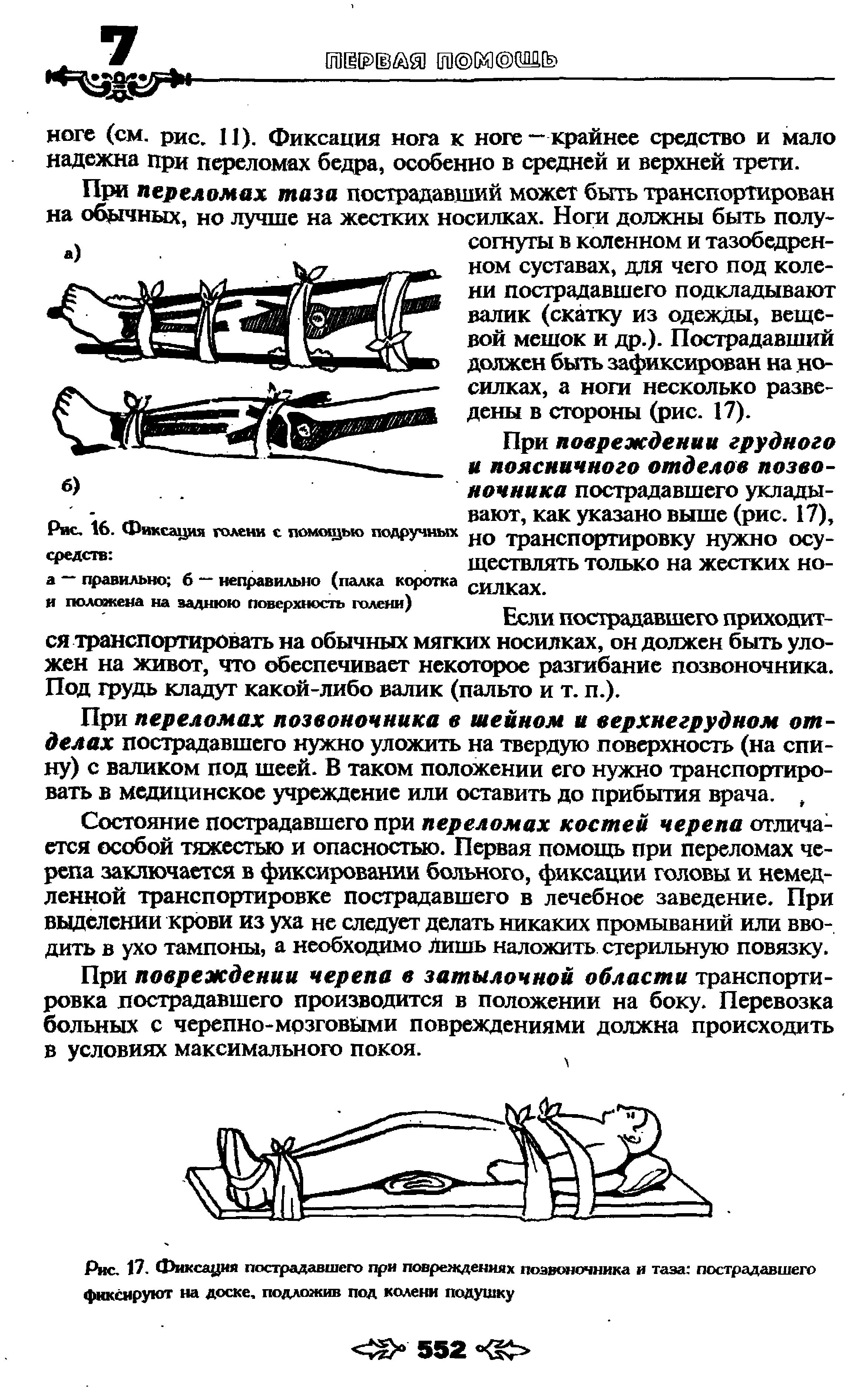 Рис. 17. Фиксация пострадавшего при повреждениях позвоночника и таза пострадавшего фиксируют на доске, подложив под колени подушку...