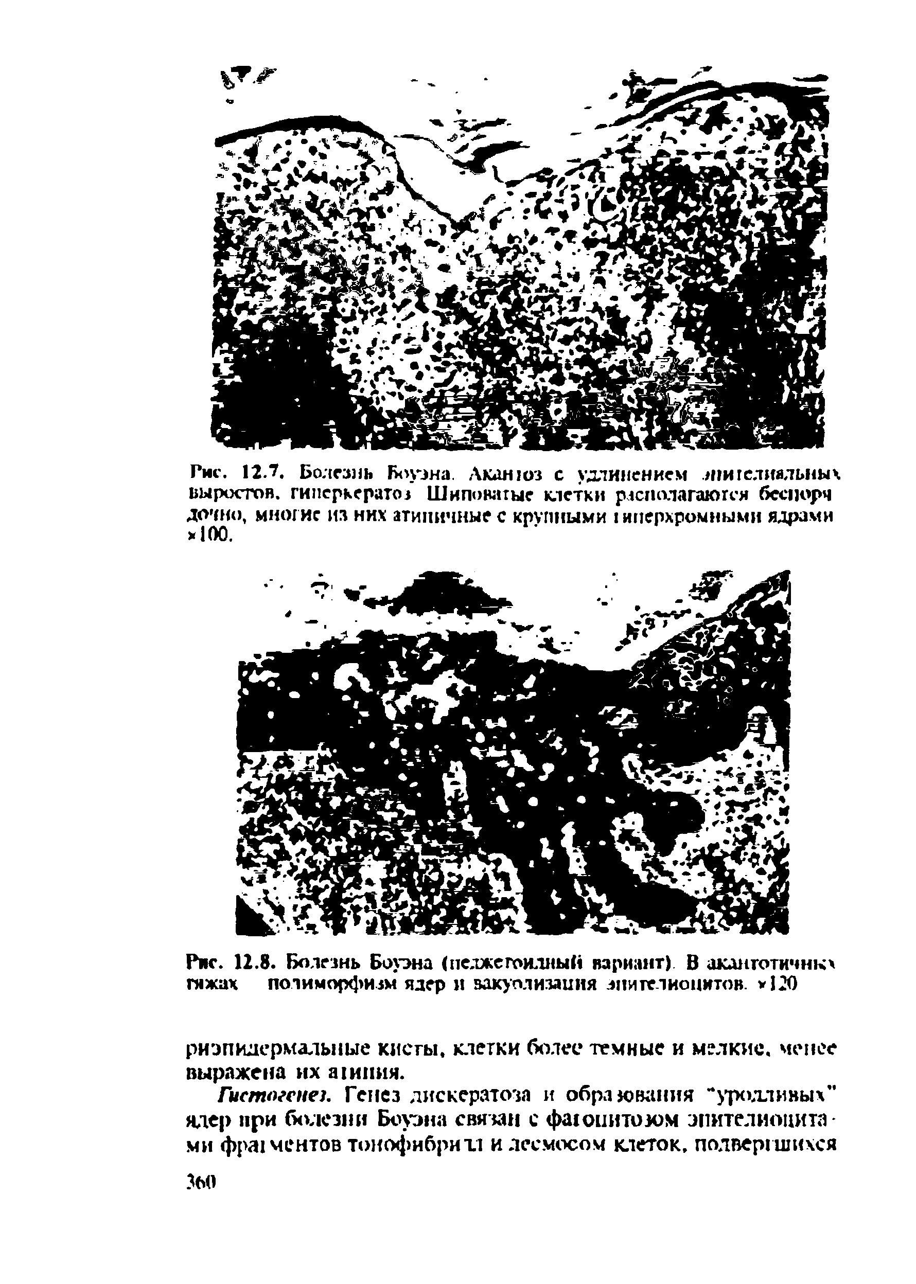Рис. 12.8. Болезнь Борна (педжетоидный вариант) В аканготичнкх тяжах полиморфизм ядер и вакуолизация эпителиоцитов. >120...