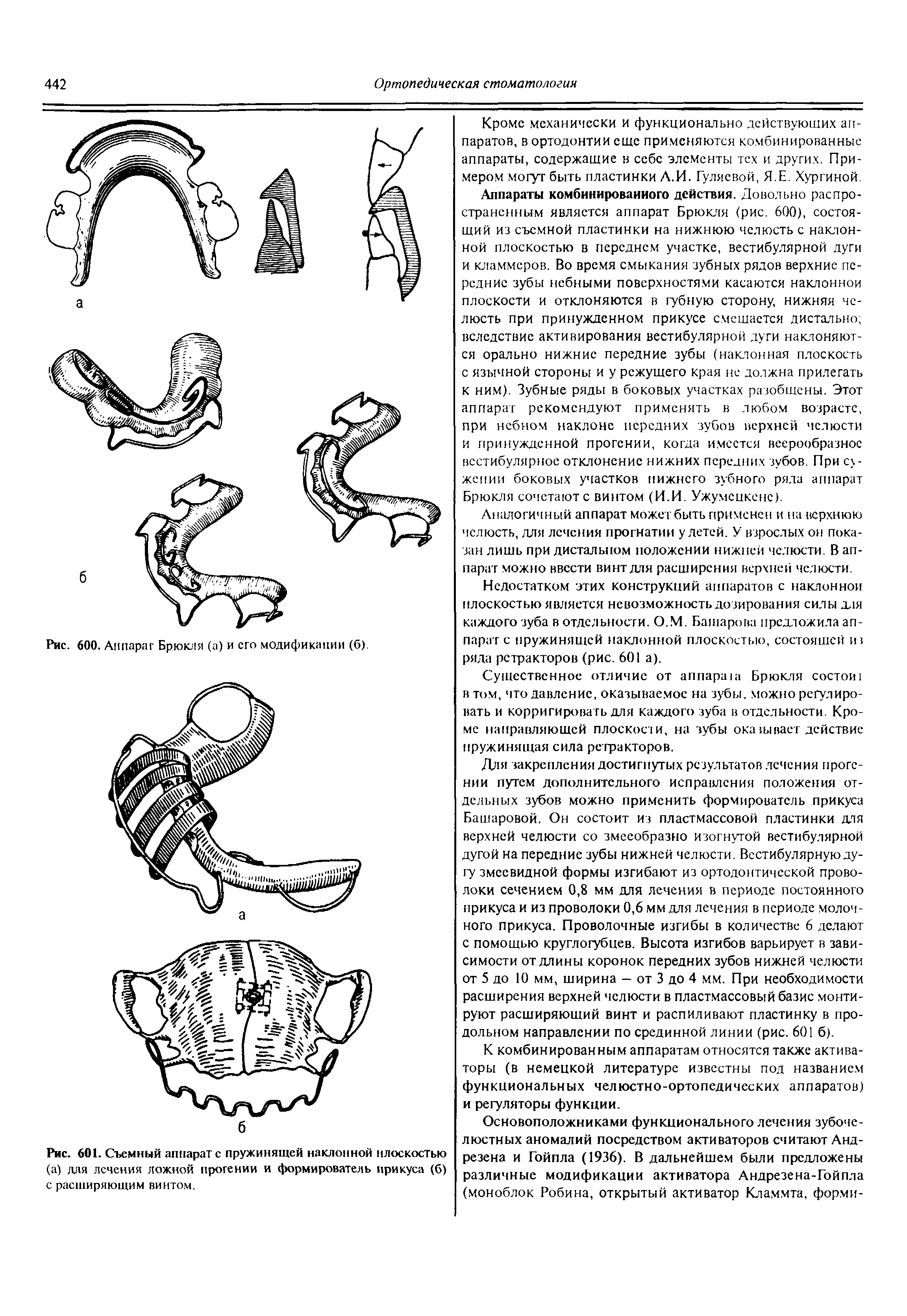 Рис. 601. Съемный аппарате пружинящей наклонной плоскостью (а) для лечения ложной прогении и формирователь прикуса (б) с расширяющим винтом.
