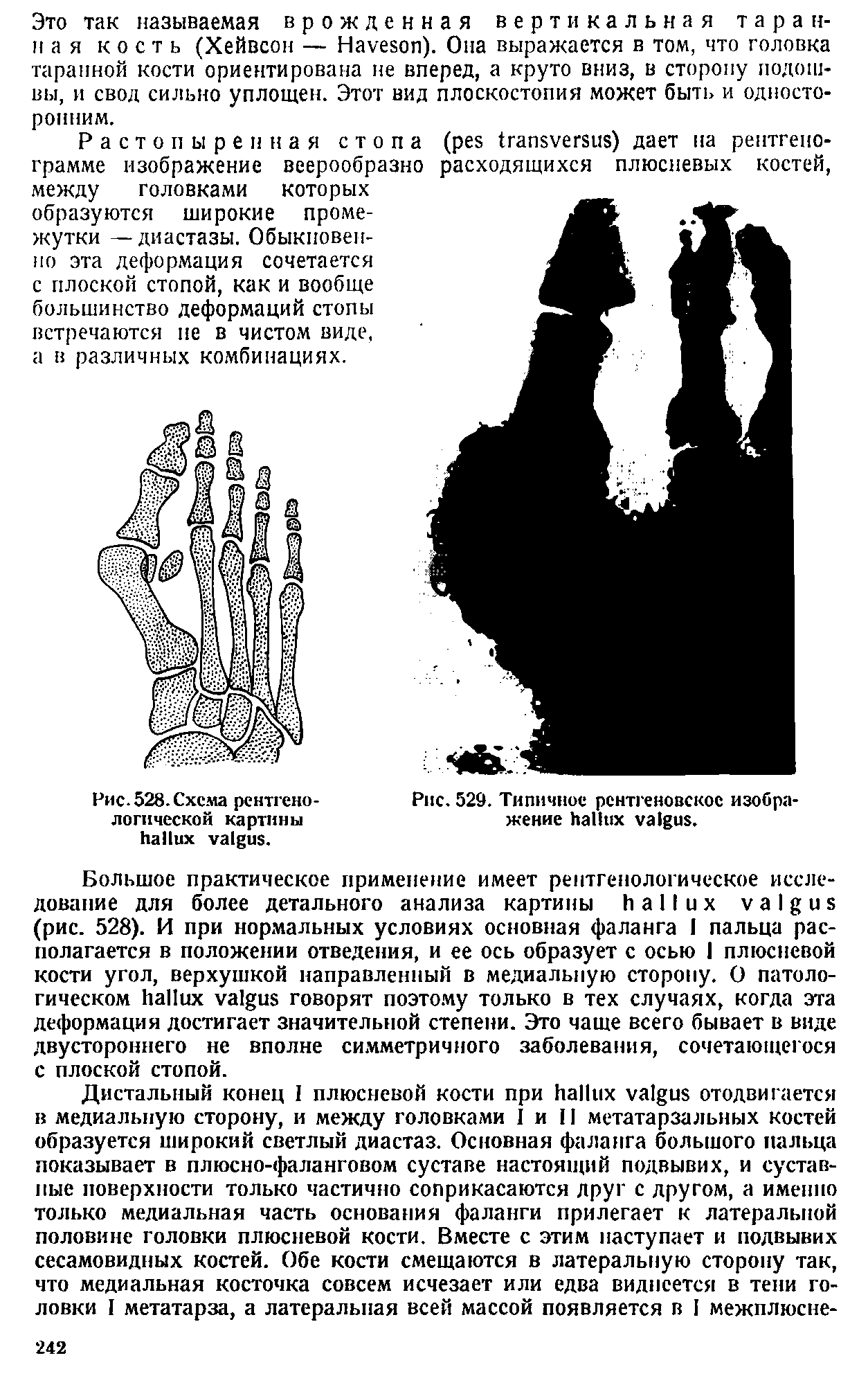 Рис. 528. Схема рентгенологической картины . Рис. 529. Типичное рентгеновское изображение .