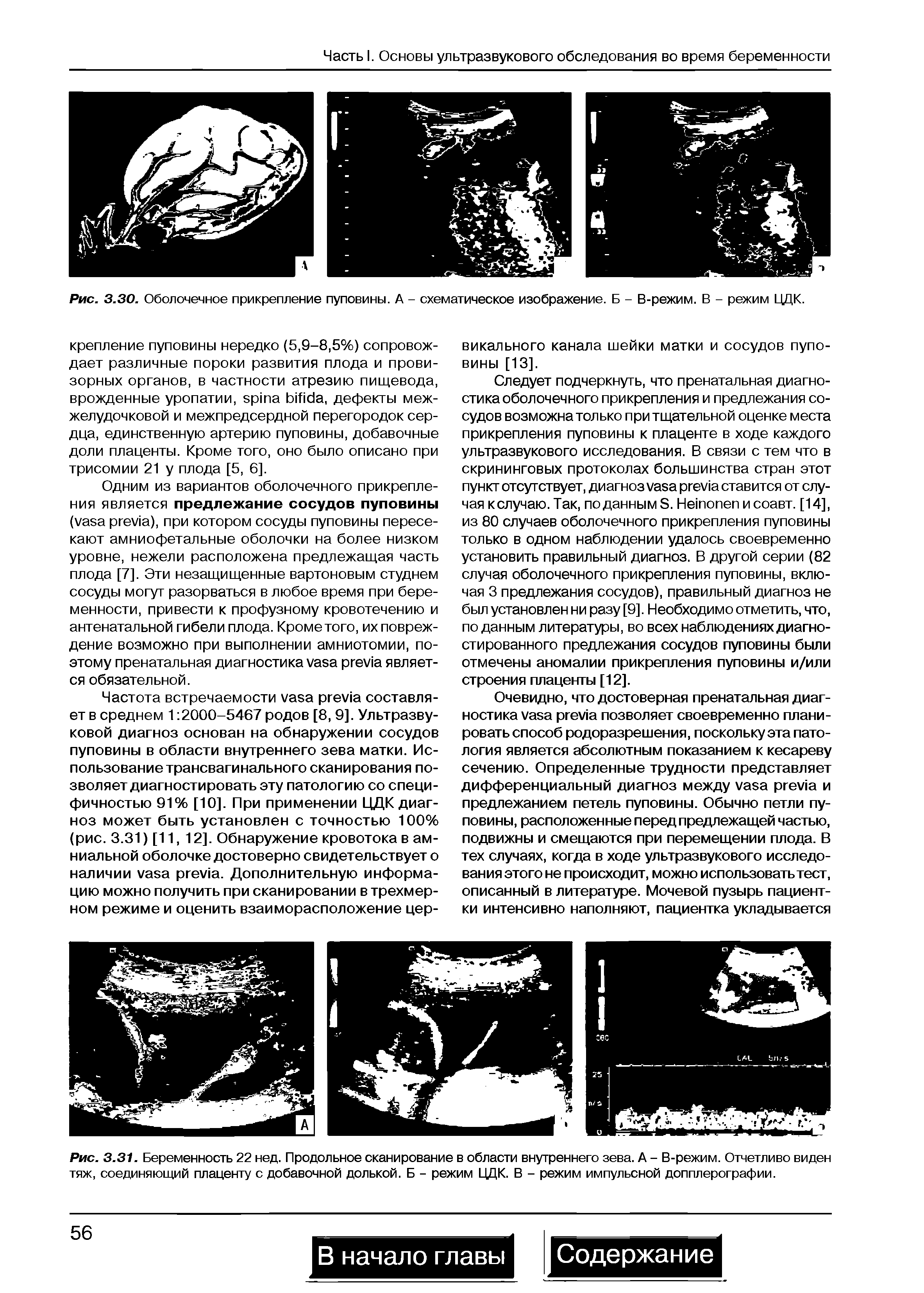 Рис. 3.30. Оболочечное прикрепление пуповины. А - схематическое изображение. Б - В-режим. В - режим ЦДК.