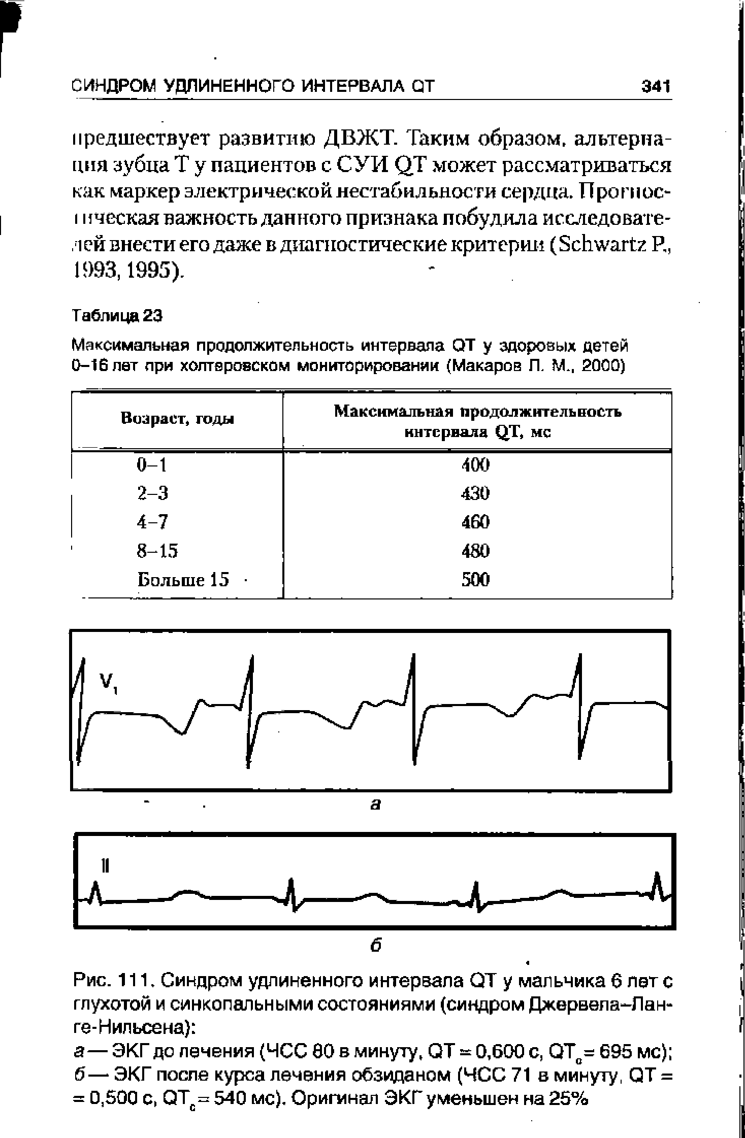 Рис. 111. Синдром удлиненного интервала QT у мальчика 6 лет с глухотой и синкопальными состояниями (синдром Джервела-Лан-ге-Нильсена) ...