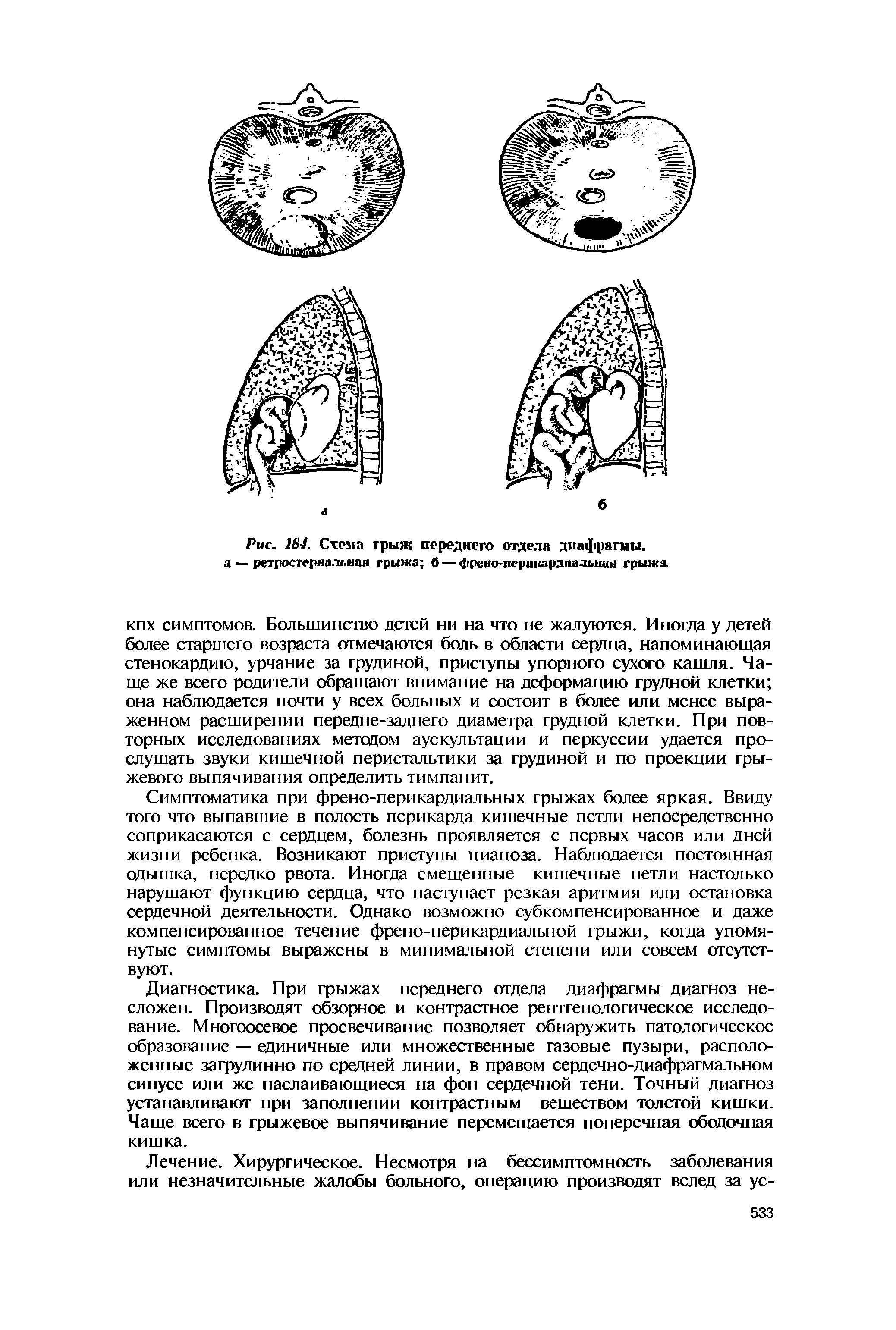 Рис. 184. Схема грыж переднего отдела диафрагмы, а — ретросгернальнан грыжа б — фрсно-перикардпалыщн грыжа.