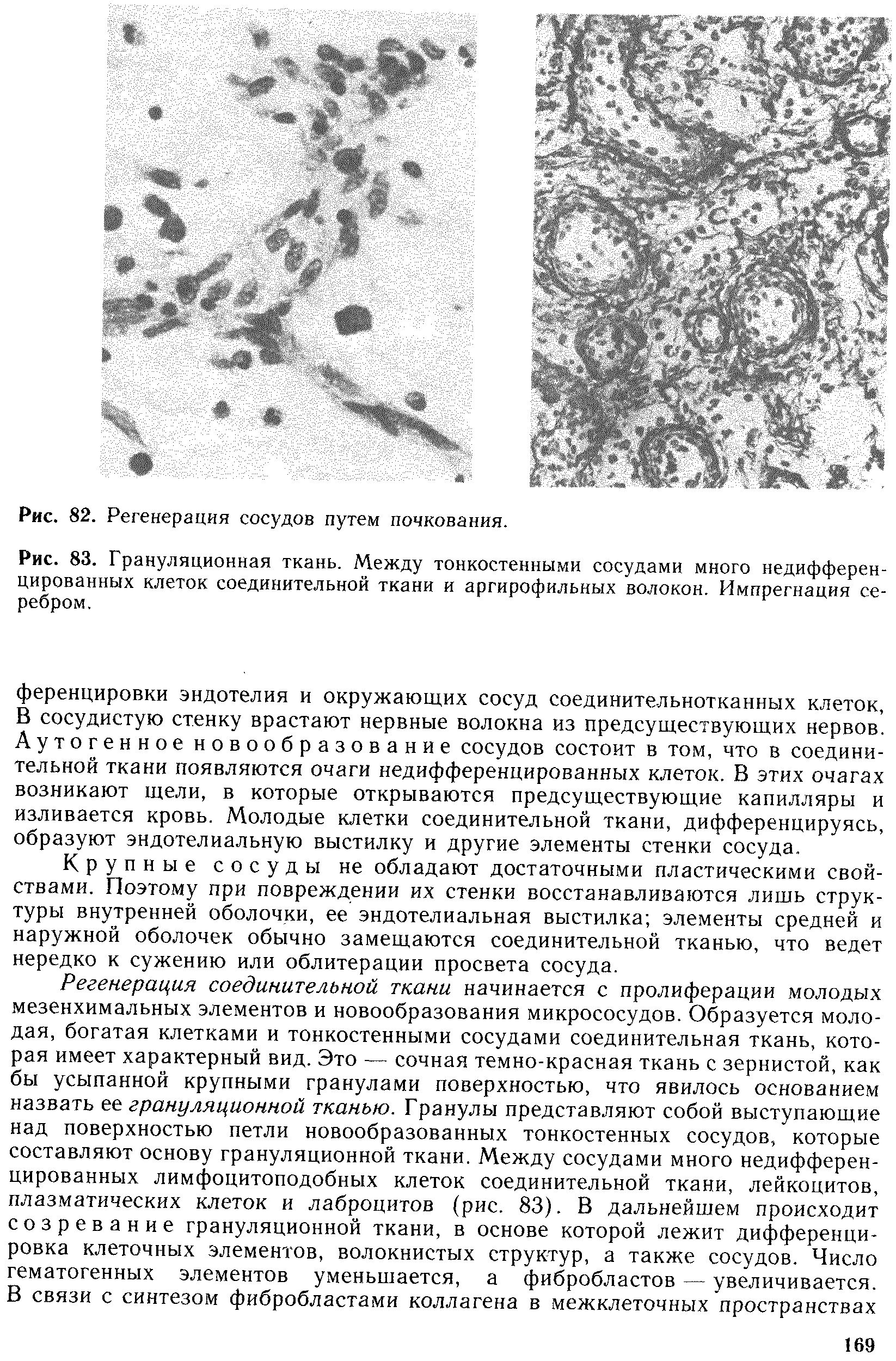 Рис. 83. Грануляционная ткань. Между тонкостенными сосудами много недифференцированных клеток соединительной ткани и аргирофильных волокон. Импрегнация серебром.