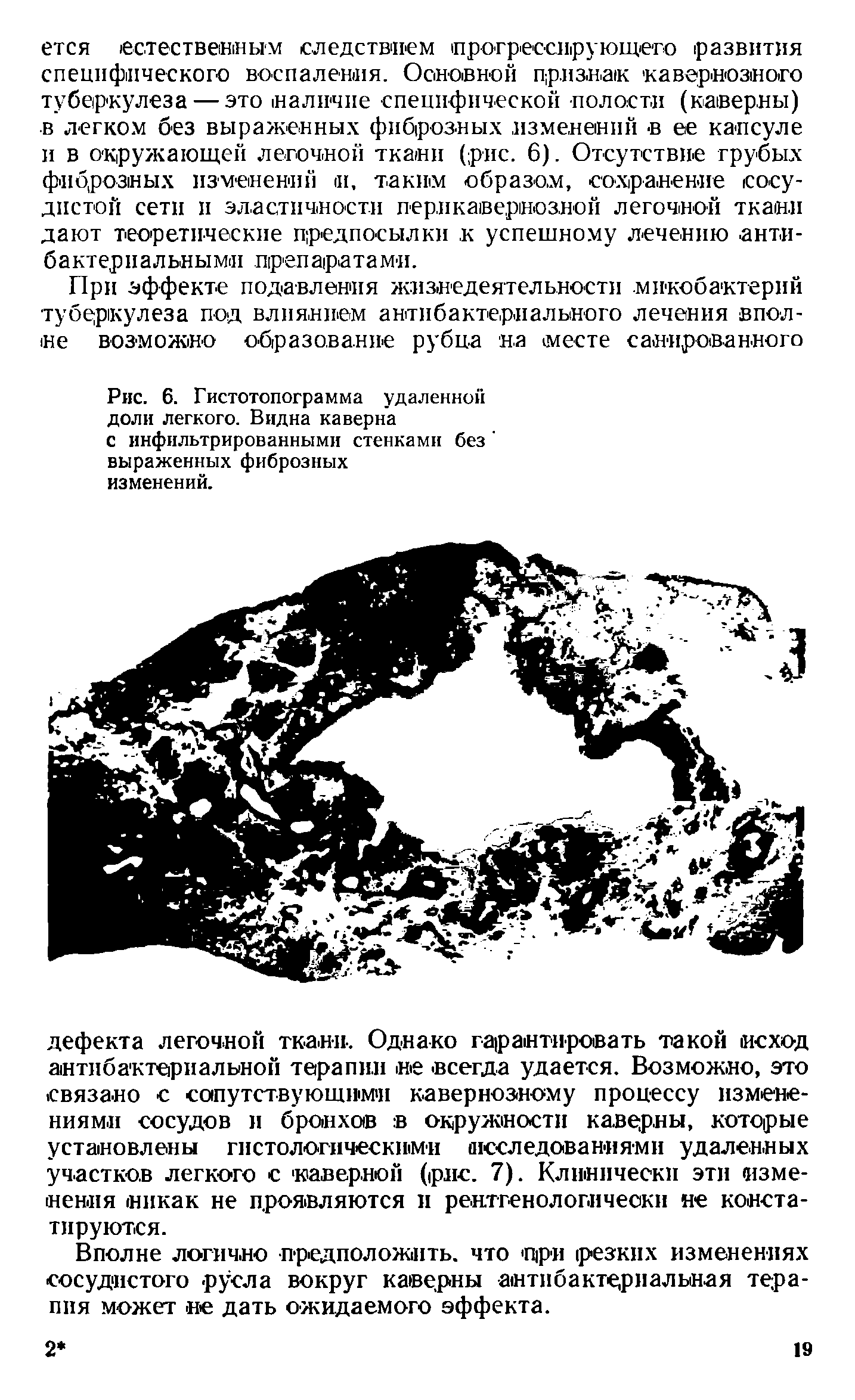 Рис. 6. Гистотопограмма удаленной доли легкого. Видна каверна с инфильтрированными стенками без выраженных фиброзных изменений.