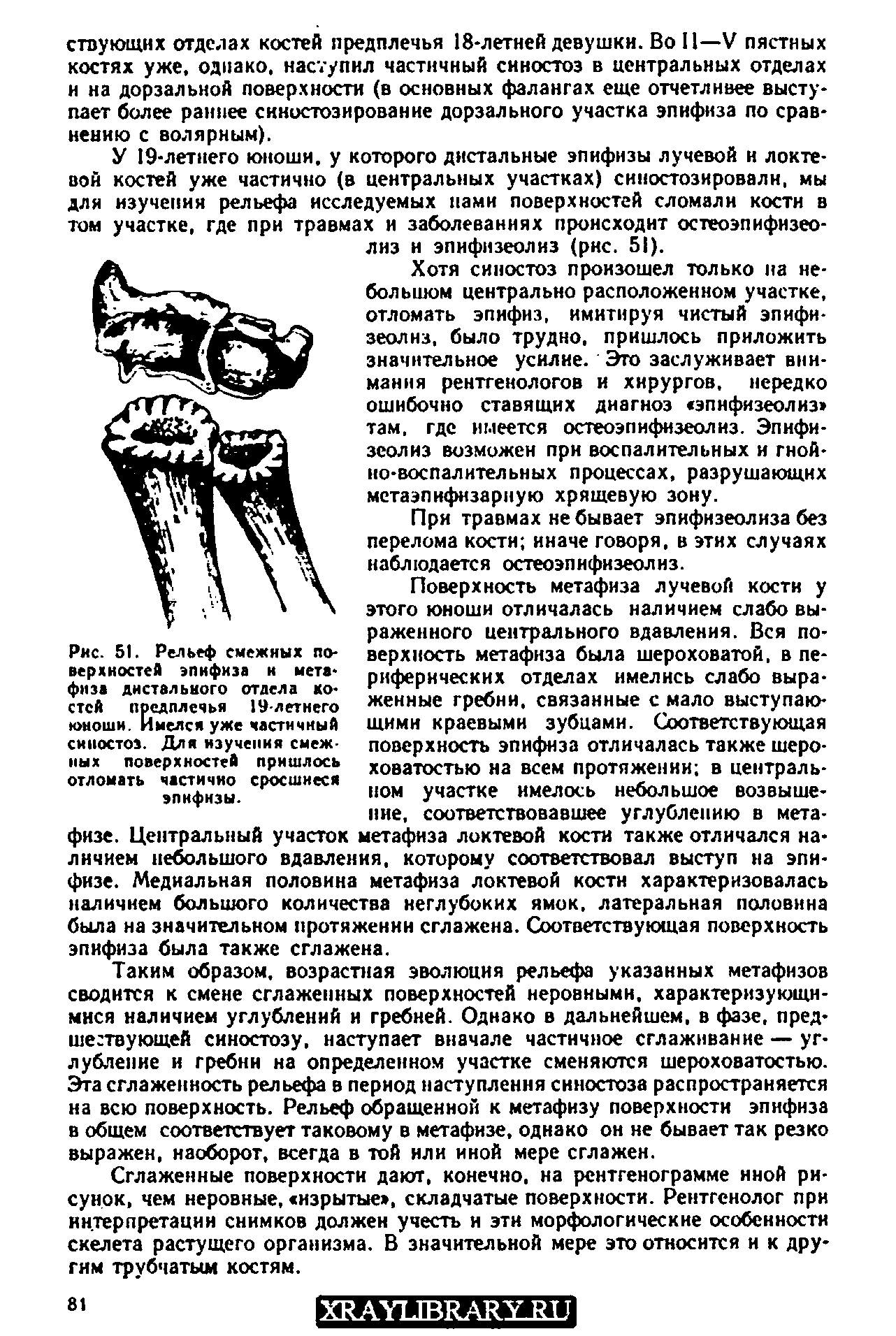 Рис. 51. Рельеф верхностей эпифиза и метафиза дистального отдела костей предплечья 19-летнего юноши. Имелся уже частичный синостоз. Для изучения смежных поверхностей пришлось отломать частично сросшиеся эпифизы.