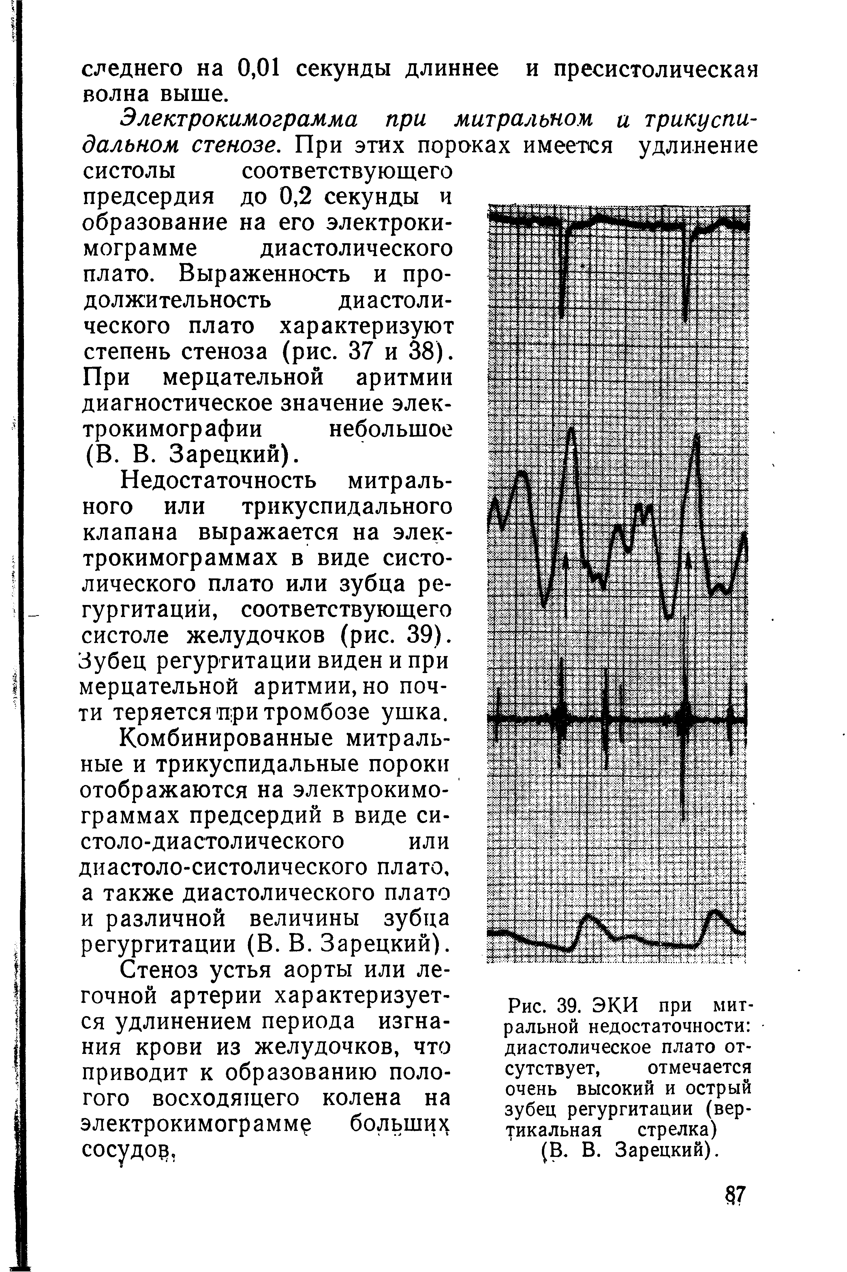 Рис. 39. ЭКИ при митральной недостаточности диастолическое плато отсутствует, отмечается очень высокий и острый зубец регургитации (вертикальная стрелка) (В. В. Зарецкий).