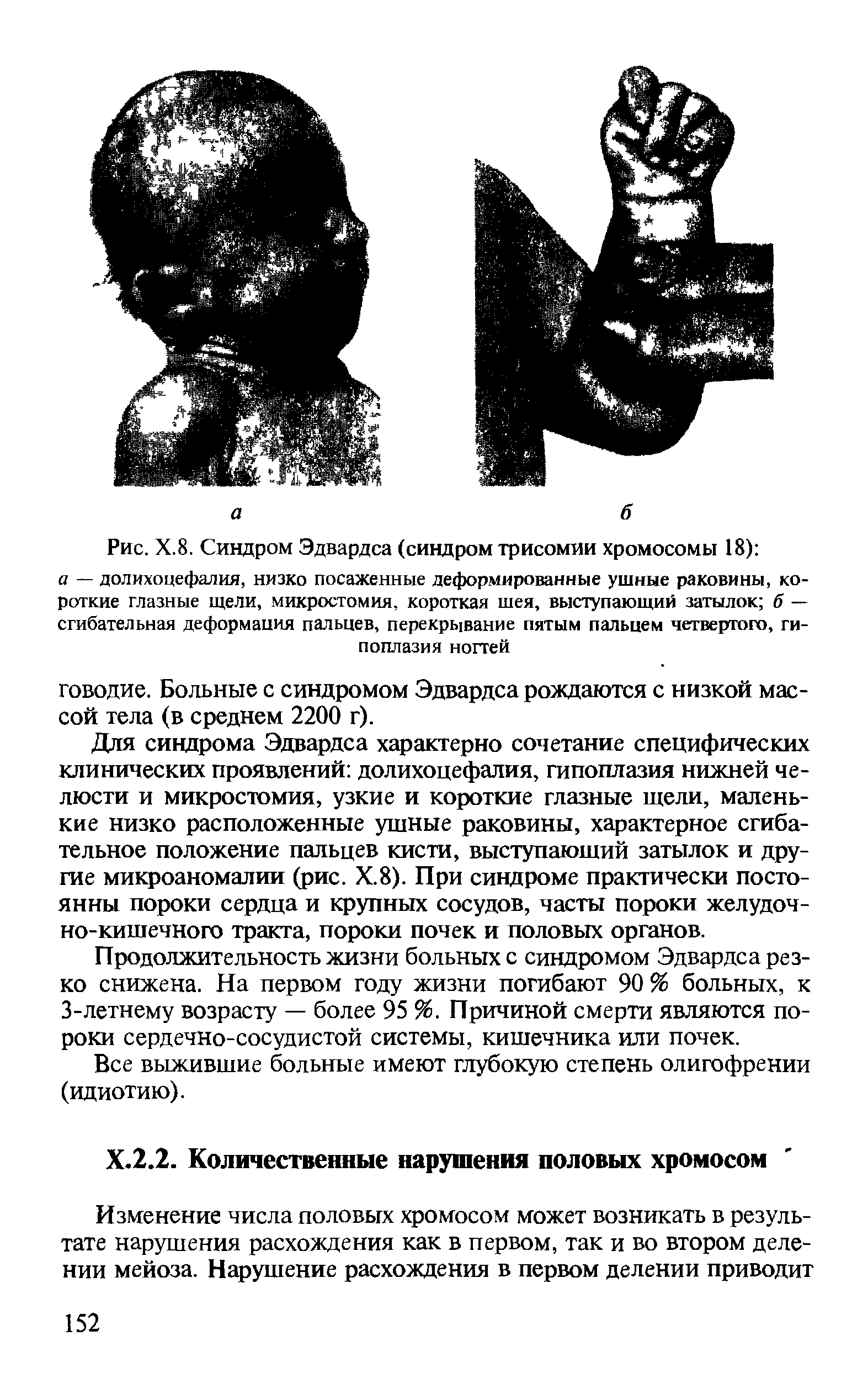 Рис. Х.8. Синдром Эдвардса (синдром трисомии хромосомы 18) а — долихоцефалия, низко посаженные деформированные ушные раковины, короткие глазные щели, микростомия, короткая шея, выступающий затылок б — сгибательная деформация пальцев, перекрывание пятым пальцем четвертого, гипоплазия ногтей...