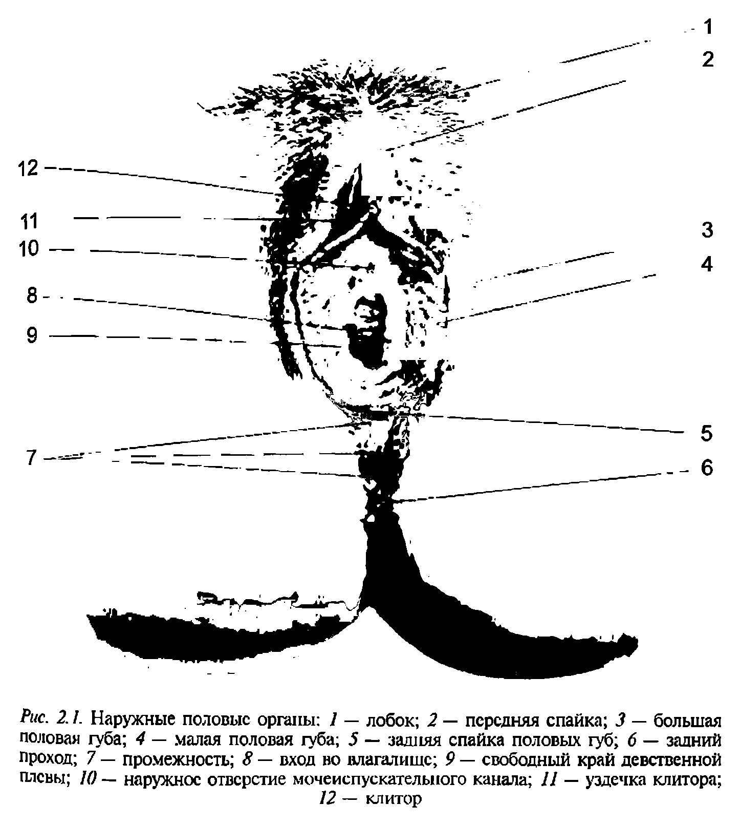 Рис. 2.1. Наружные половые органы 1 — лобок 2 — передняя спайка 3 — большая половая губа 4 — малая половая губа 5 — задняя спайка половых губ 6 — задний проход 7 — промежность 8 — вход во влагалище 9 — свободный край девственной плевы К) — наружное отверстие мочеиспускательного канала 11 — уздечка клитора ...