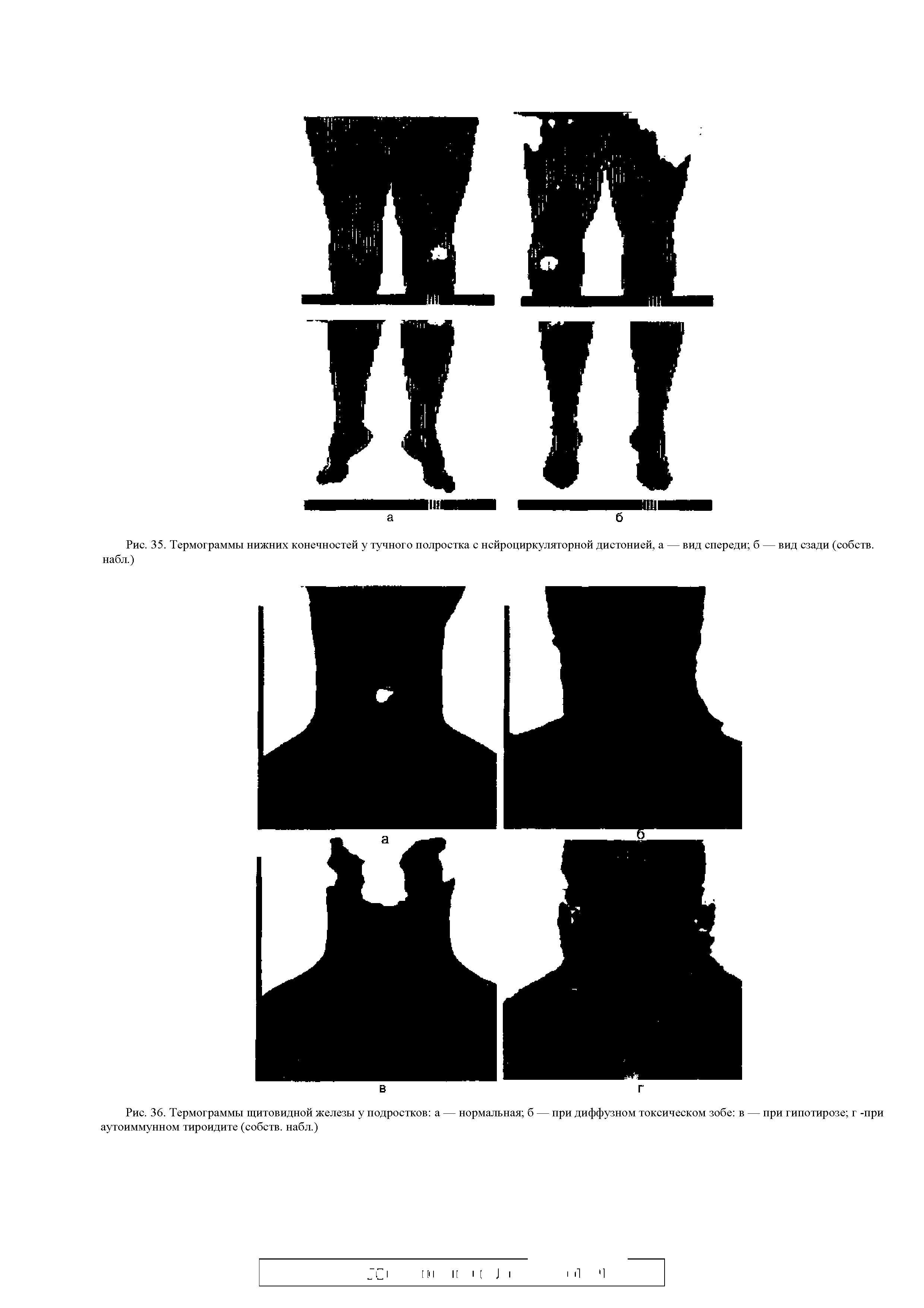 Рис. 36. Термограммы щитовидной железы у подростков а — нормальная б — при диффузном токсическом зобе в — при гипотирозе г -при аутоиммунном тироидите (собств. набл.)...
