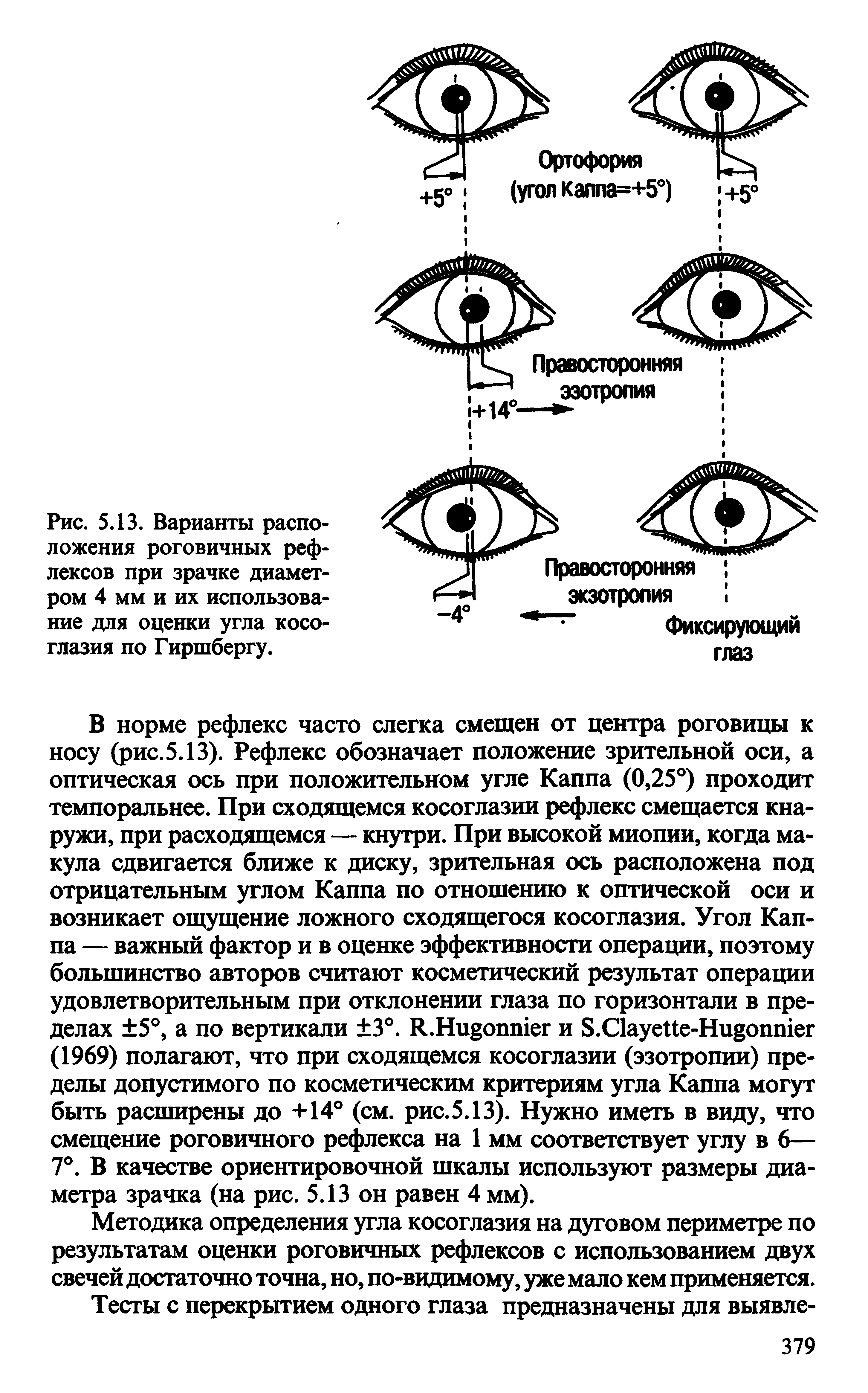 Рис. 5.13. Варианты расположения роговичных рефлексов при зрачке диаметром 4 мм и их использование для оценки угла косоглазия по Гиршбергу.