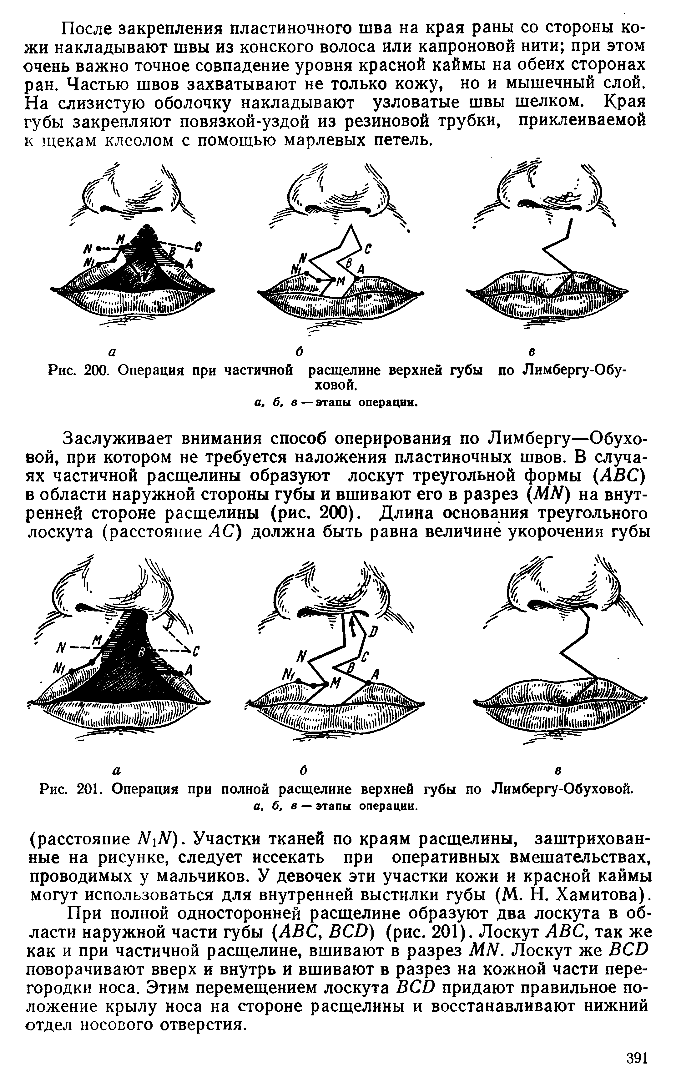 Рис. 200. Операция при частичной расщелине верхней губы по Лимбергу-Обу-ховой.