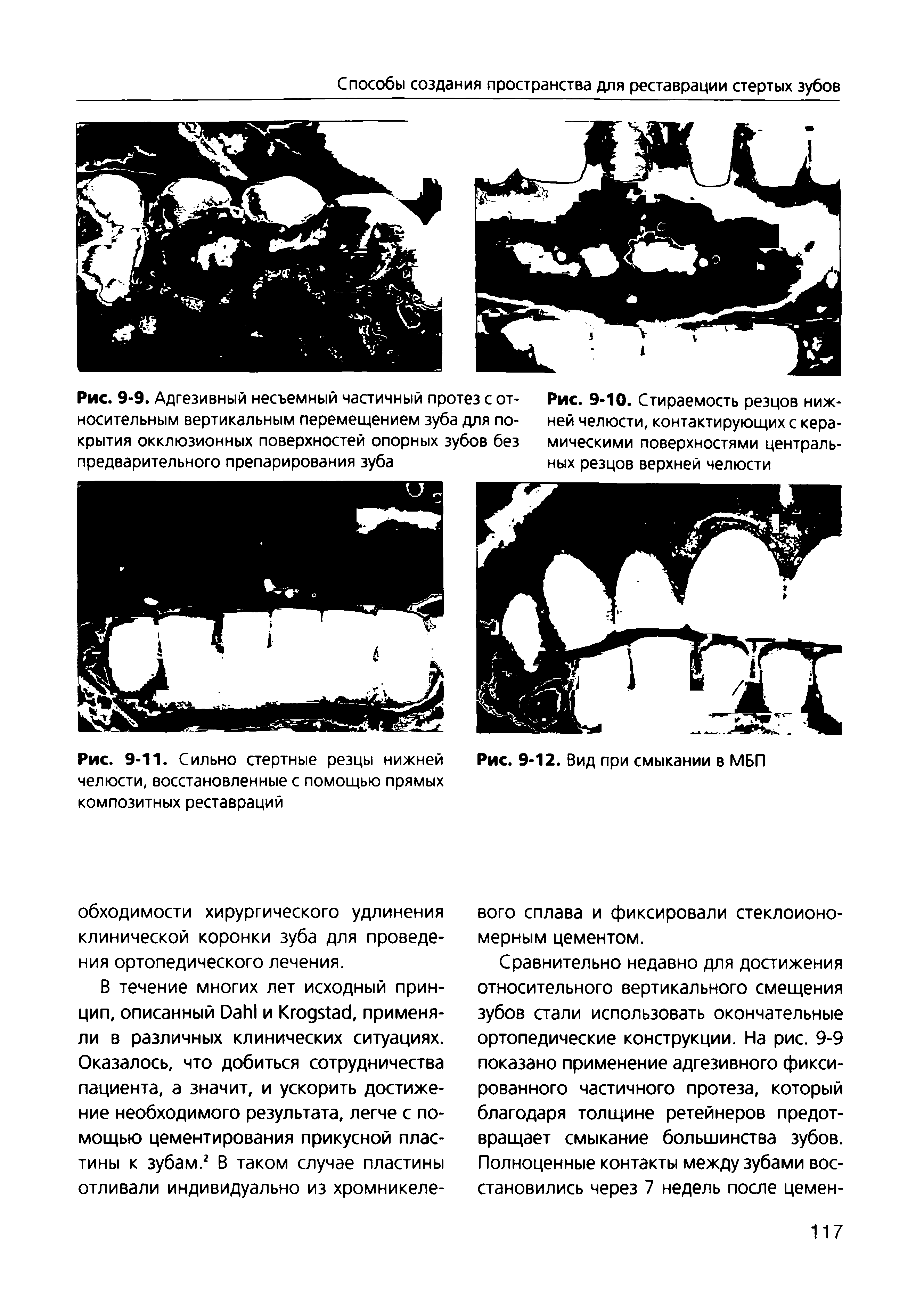 Рис. 9-11. Сильно стертные резцы нижней челюсти, восстановленные с помощью прямых композитных реставраций...