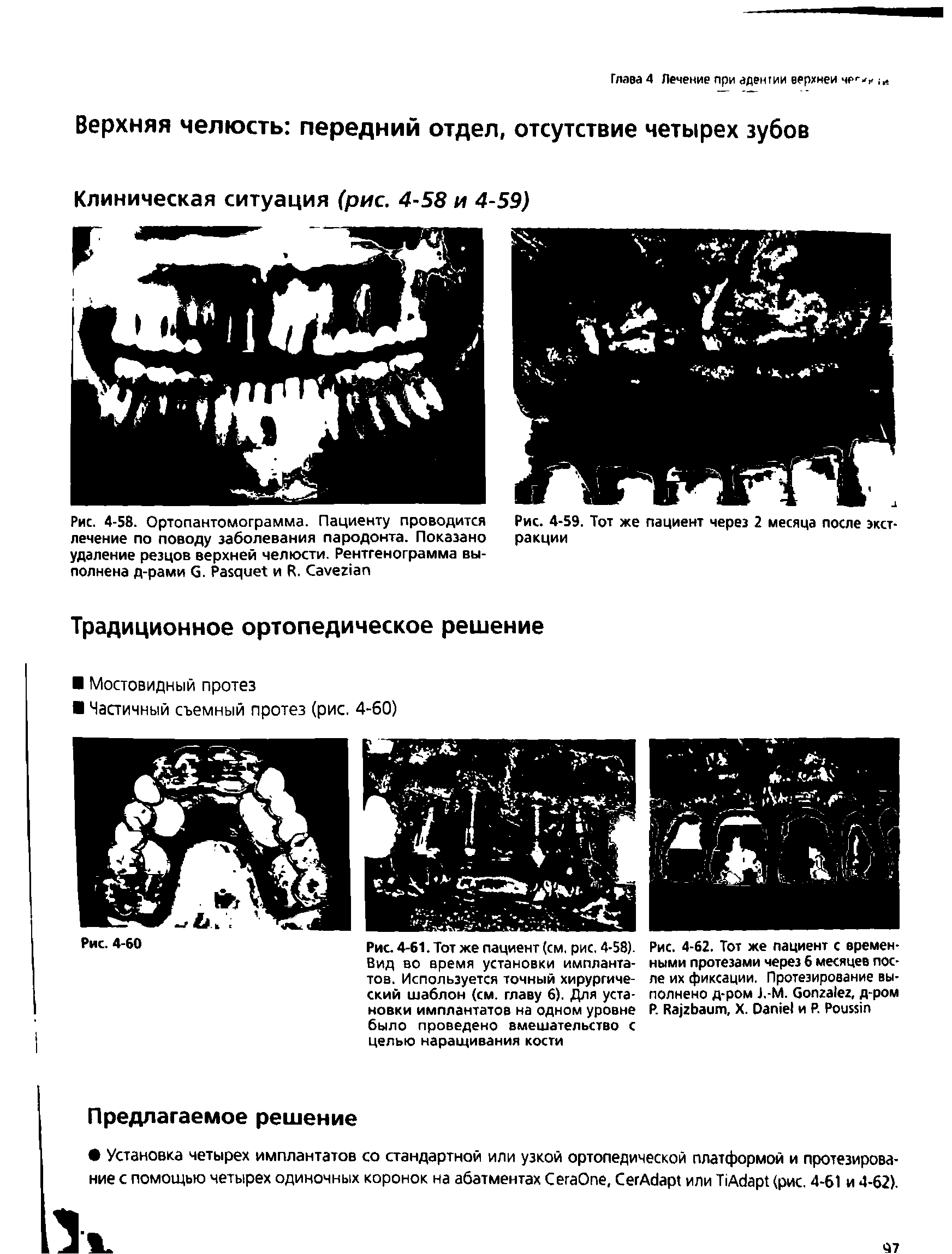 Рис. 4-61. Тот же пациент (см. рис. 4-58). Вид во время установки имплантатов. Используется точный хирургический шаблон (см. главу 6). Для установки имплантатов на одном уровне было проведено вмешательство с целью наращивания кости...